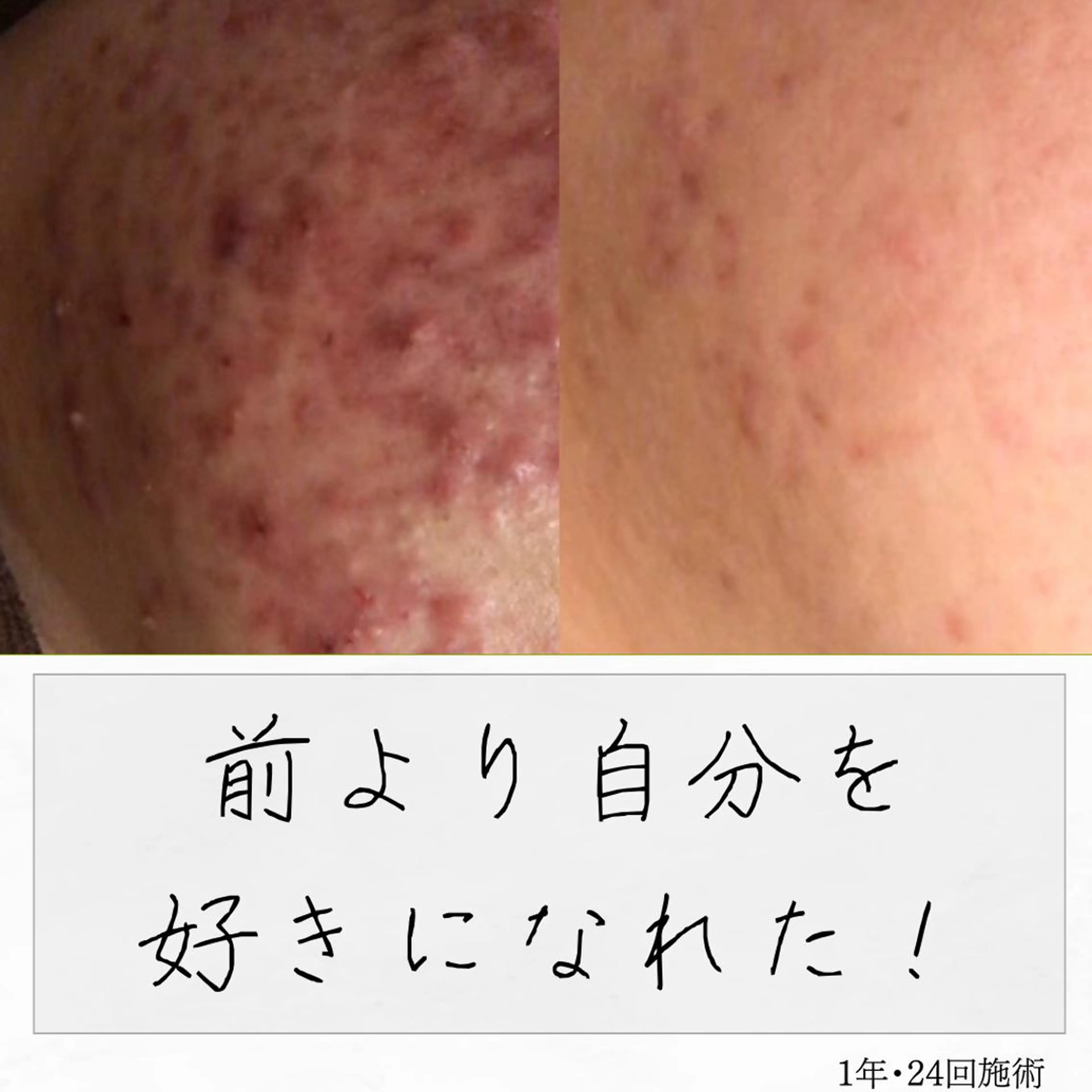 ニキビ経験者が施術 する専門サロン🌻のエステ・リラクイメージ