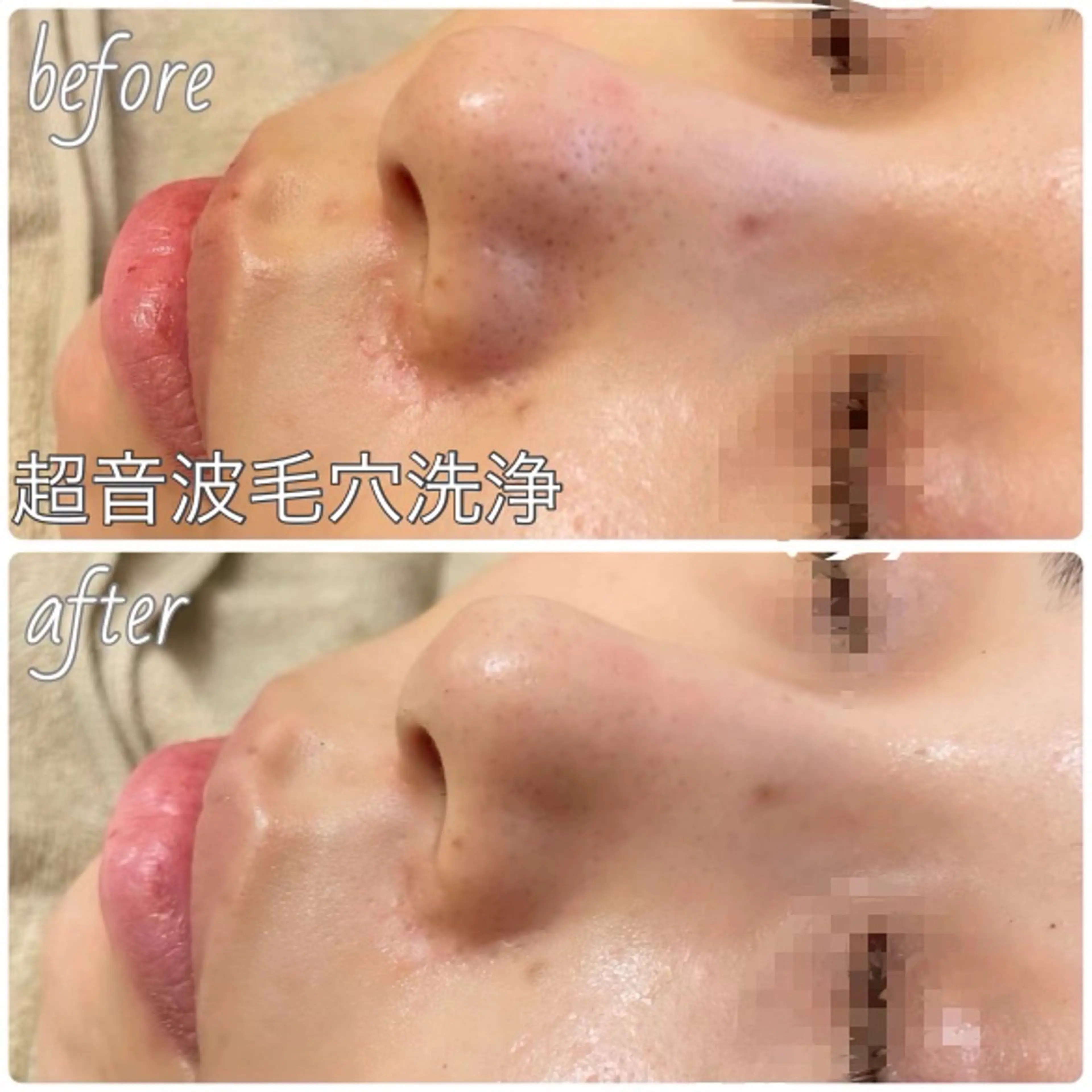 Belsia千歳烏山 ピーリング＆眉毛のエステ・リラクイメージ