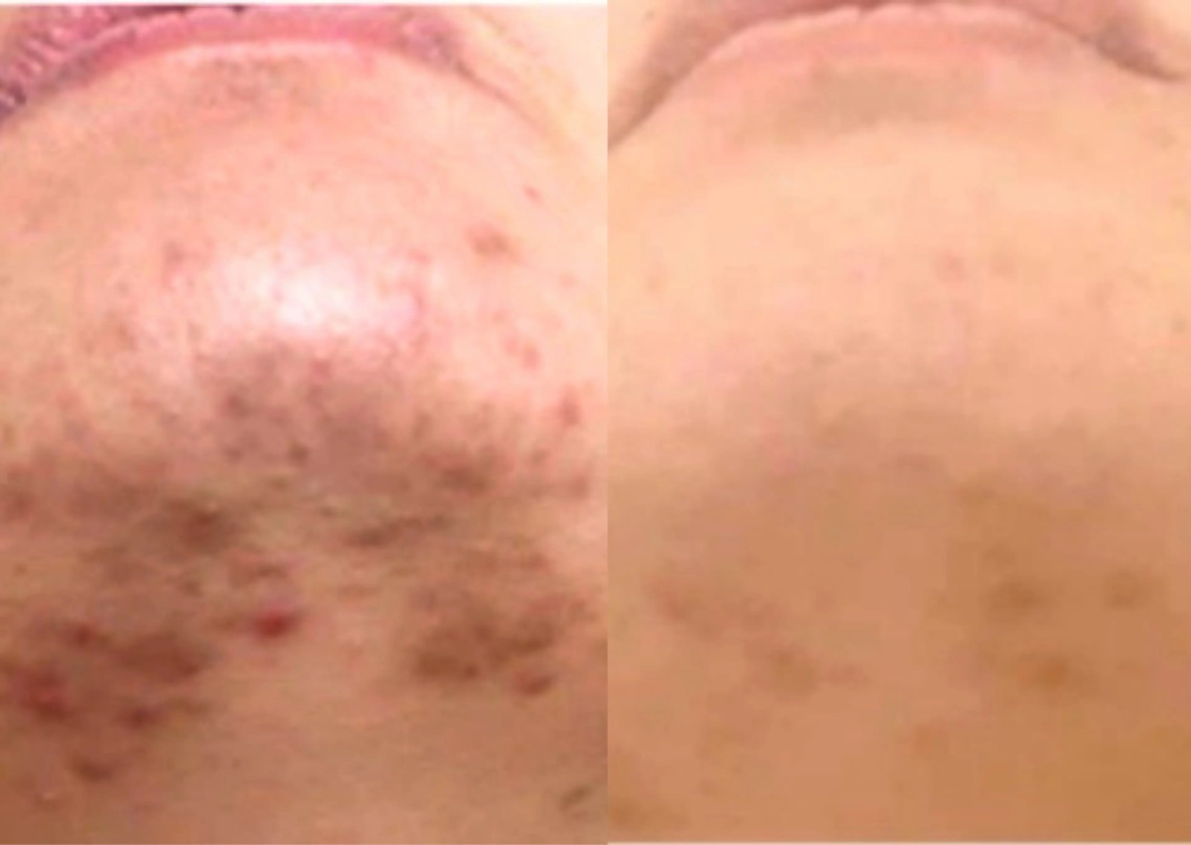 ハーブピーリング 脱毛専門店ALTOのエステ・リラクイメージ