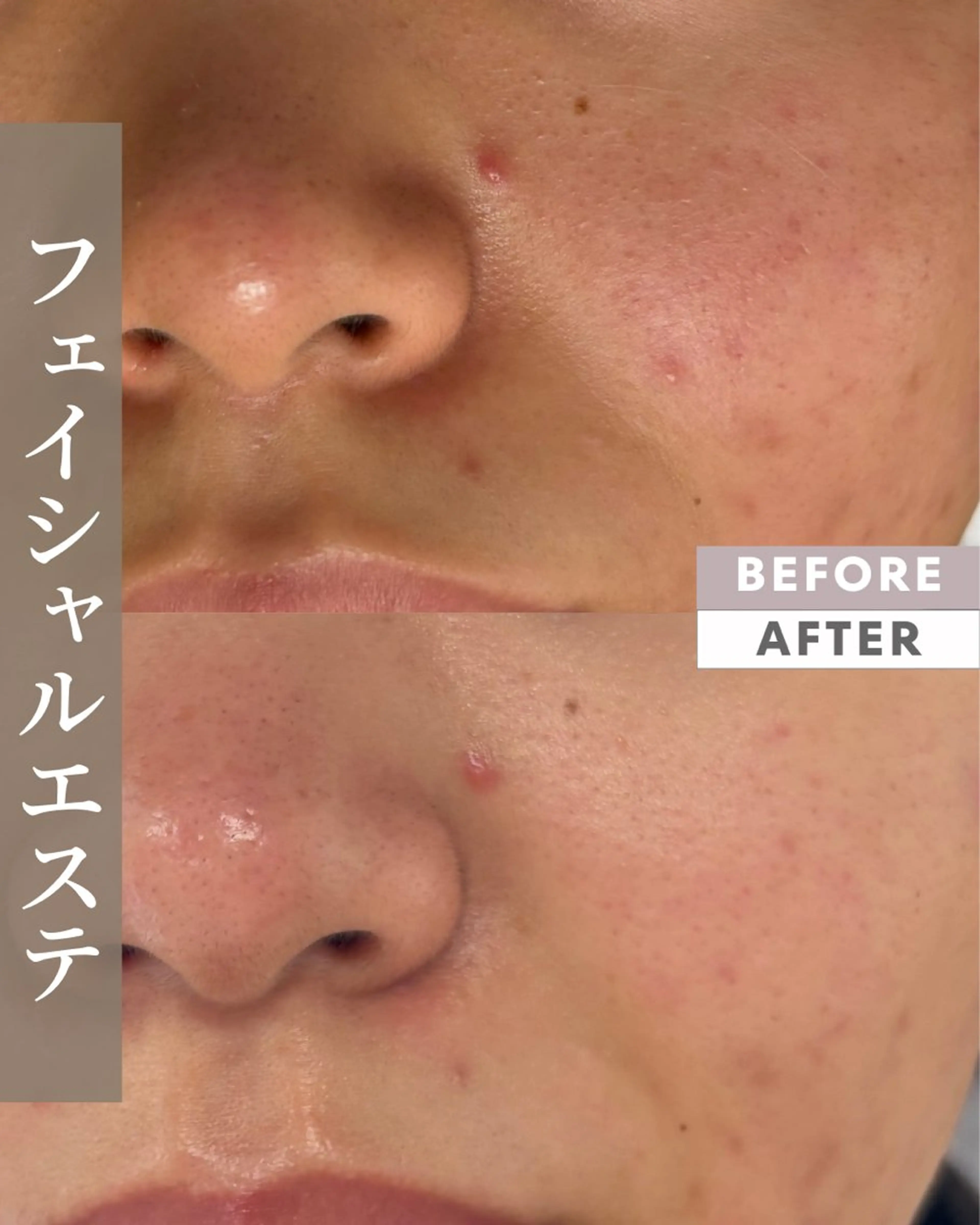 初回限定＊肌質改善フェイシャルの写真