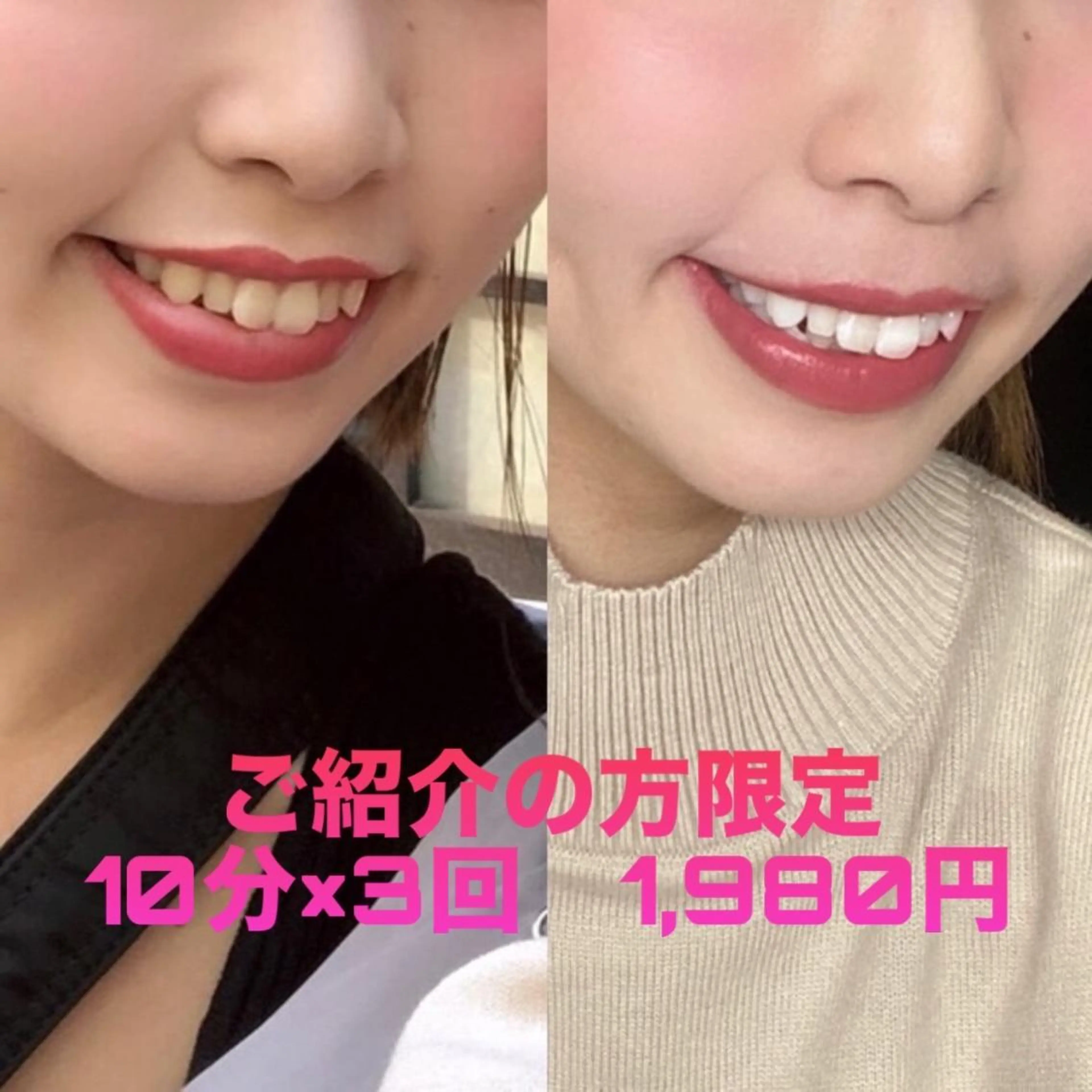 👭ご紹介の方限定👭セルフホワイトニング初回体験10分×3回　¥1,980の写真