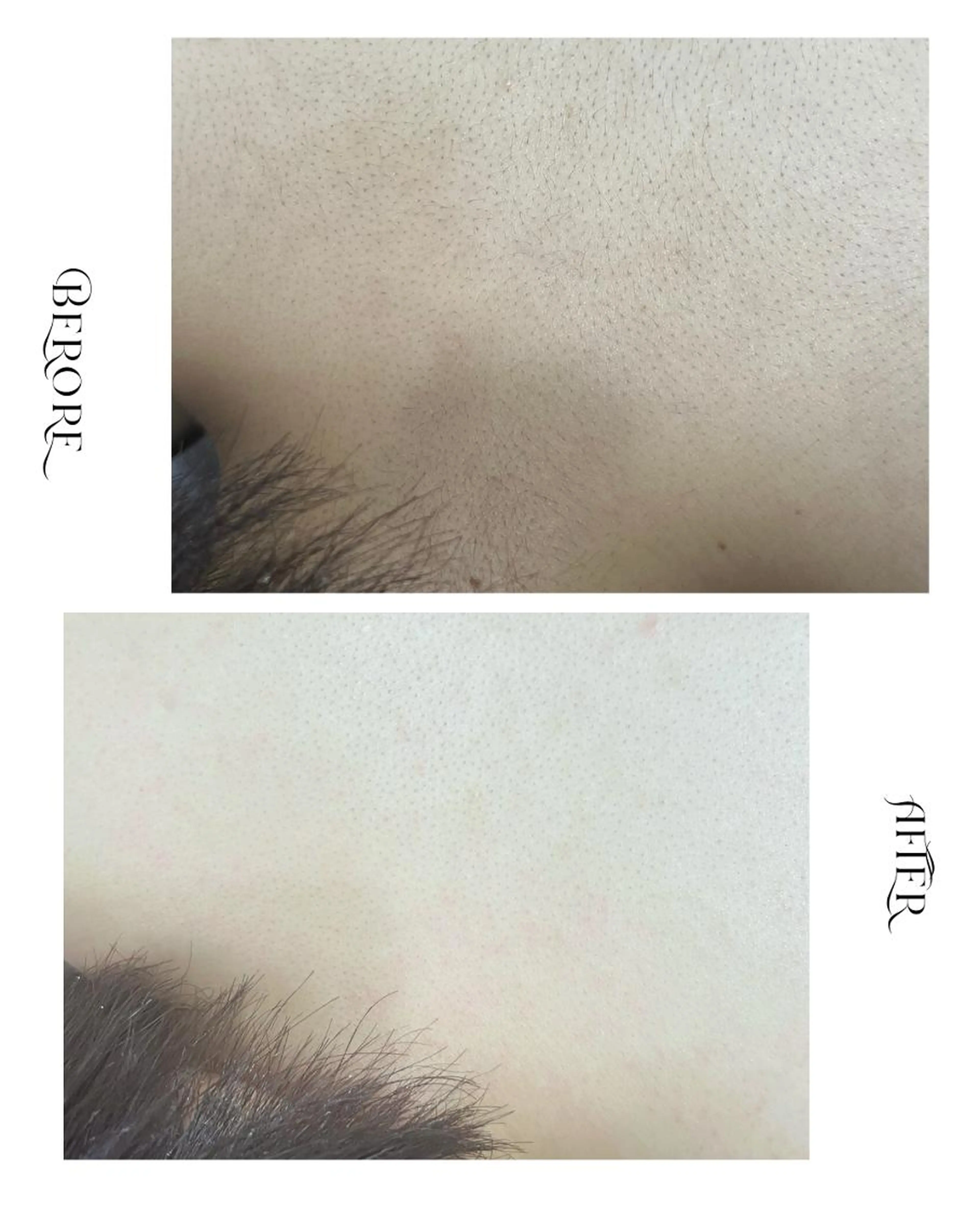 《背中美人｜首元スッキリ》背中＋うなじワックス脱毛の写真