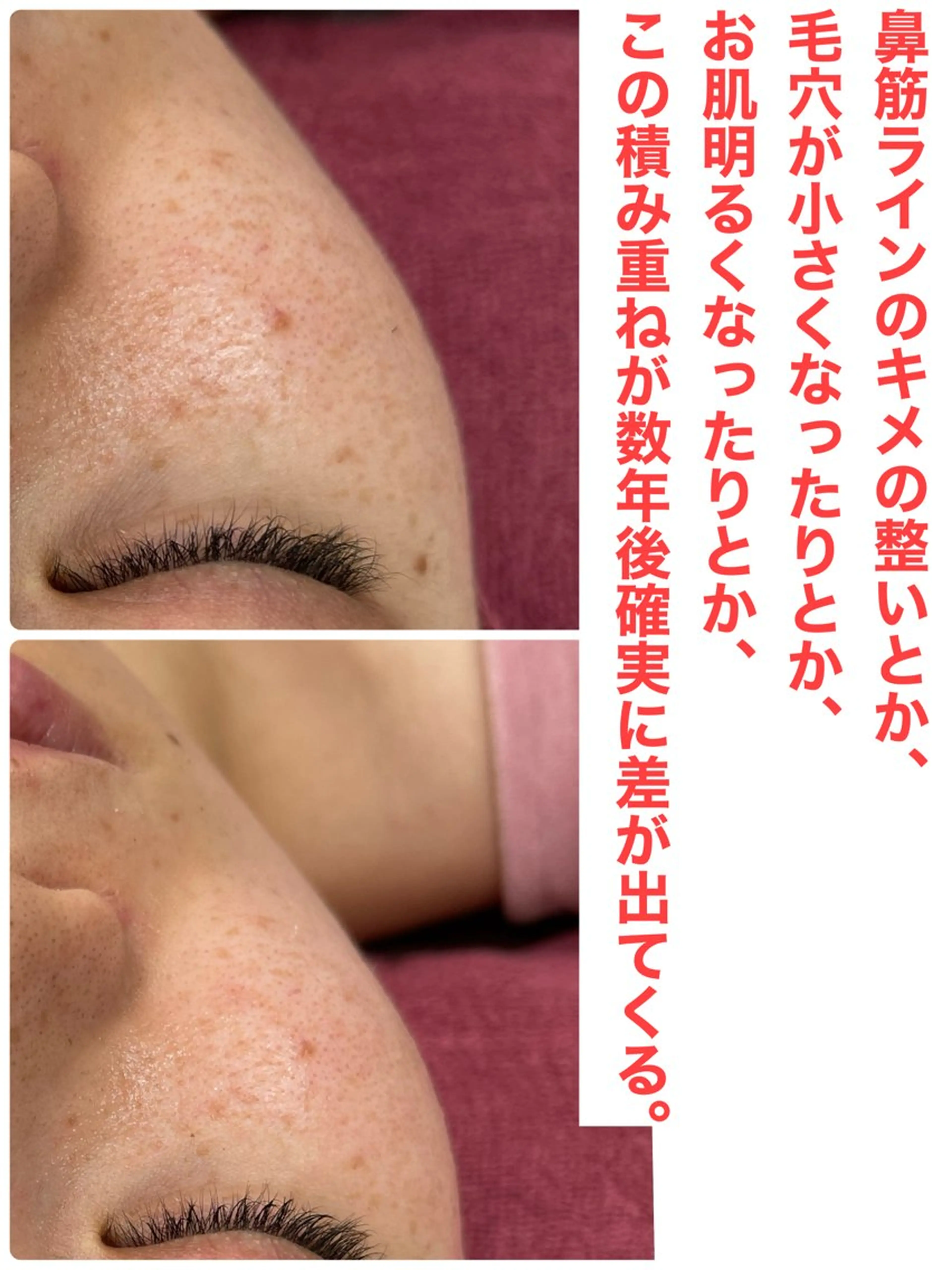 エステ Chalon所属・REVI取扱・肌悩み 毛穴Chalonのエステ・リラクイメージ