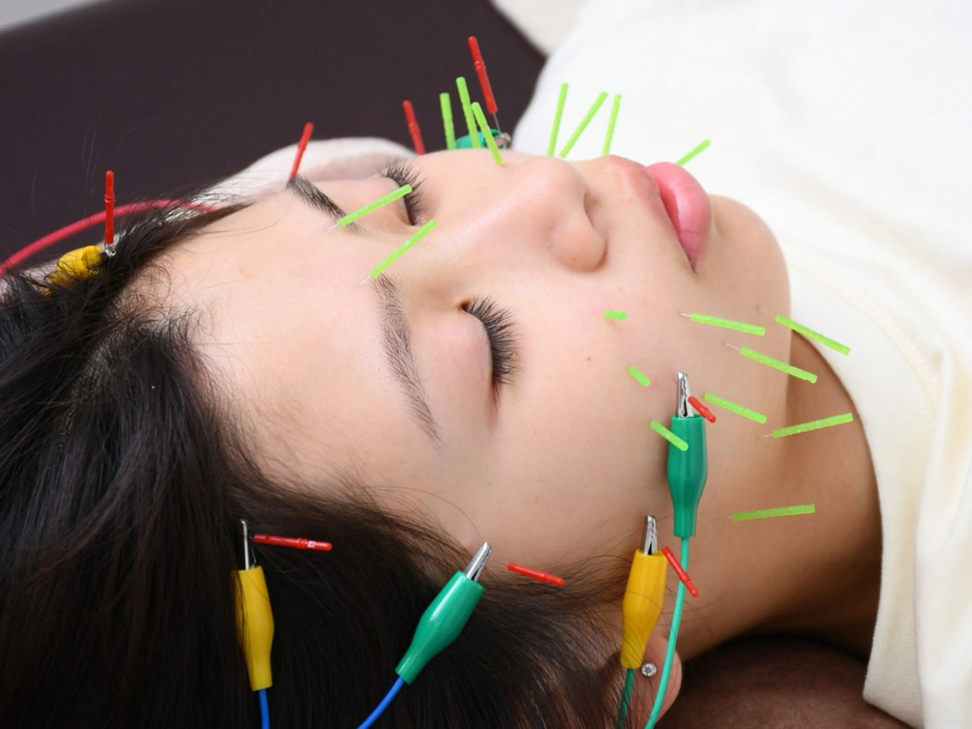 【美容鍼灸が初めての方におすすめ】★美容鍼+小顔矯正★ 初回¥5.500（ニキビ/肌質改善/たるみ）の写真