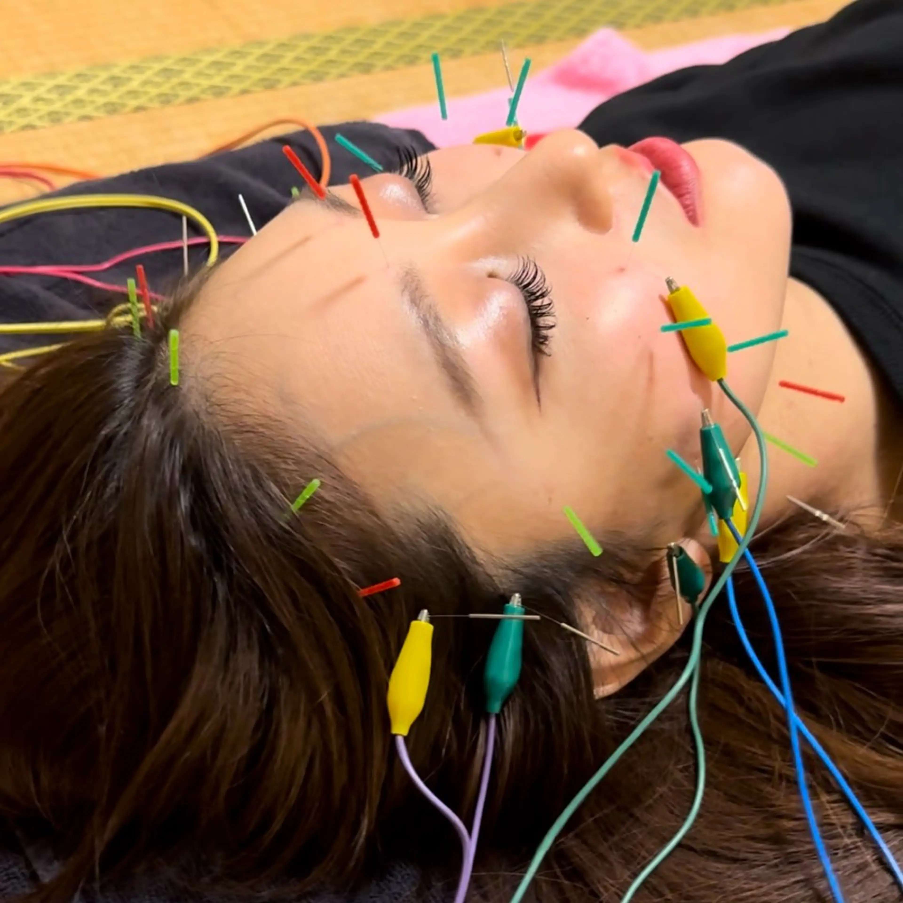 人気No.1✨【たるみ解消/むくみ/美肌/リフトアップ/小顔効果/エラ張り軽減】小顔矯正＋リフトUP美容鍼 60分の写真