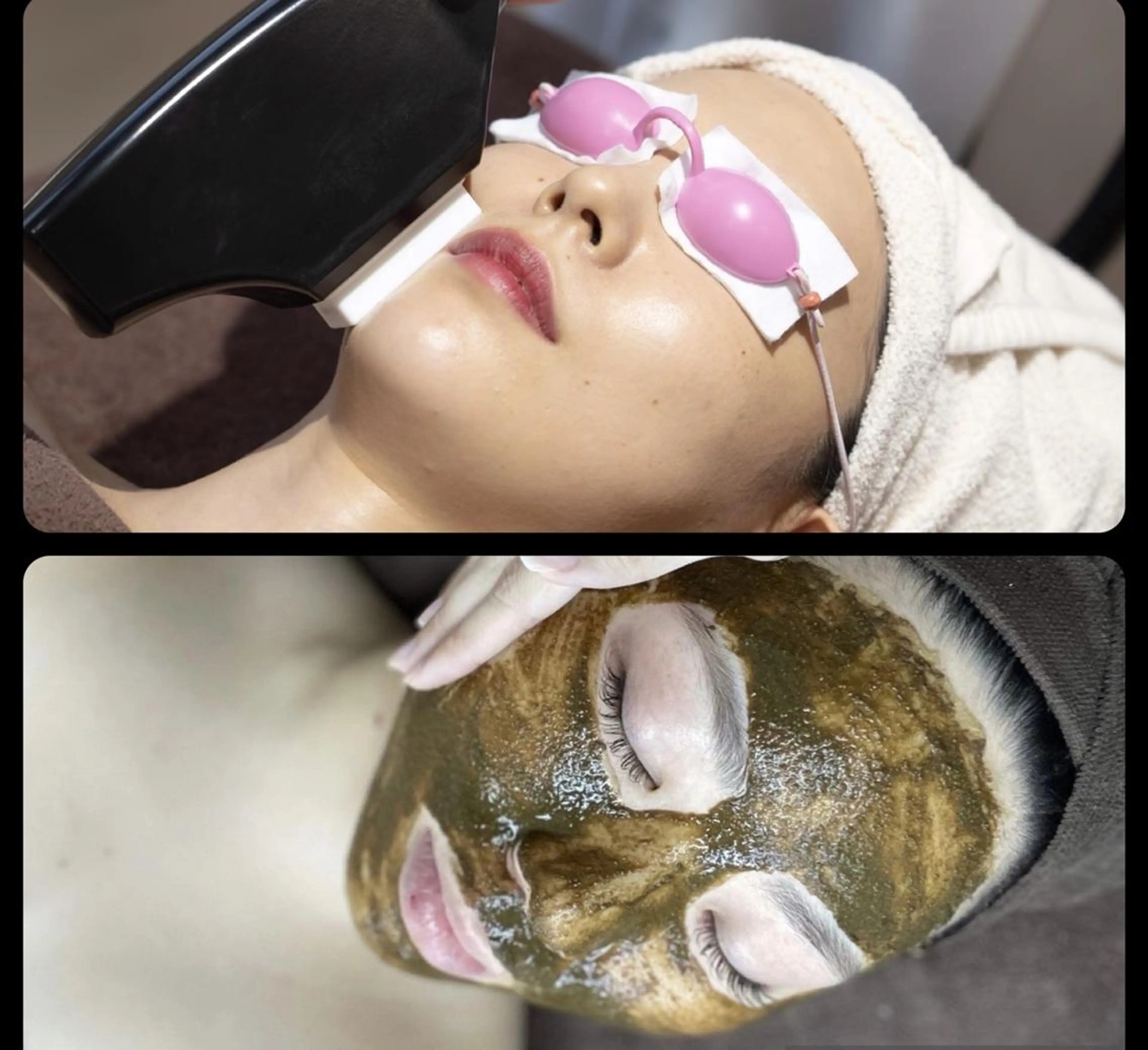 《期間限定》【お顔ハーブピーリング×顔脱毛】スペシャルメニュー♪ニキビ/毛穴/くすみにも◎の写真