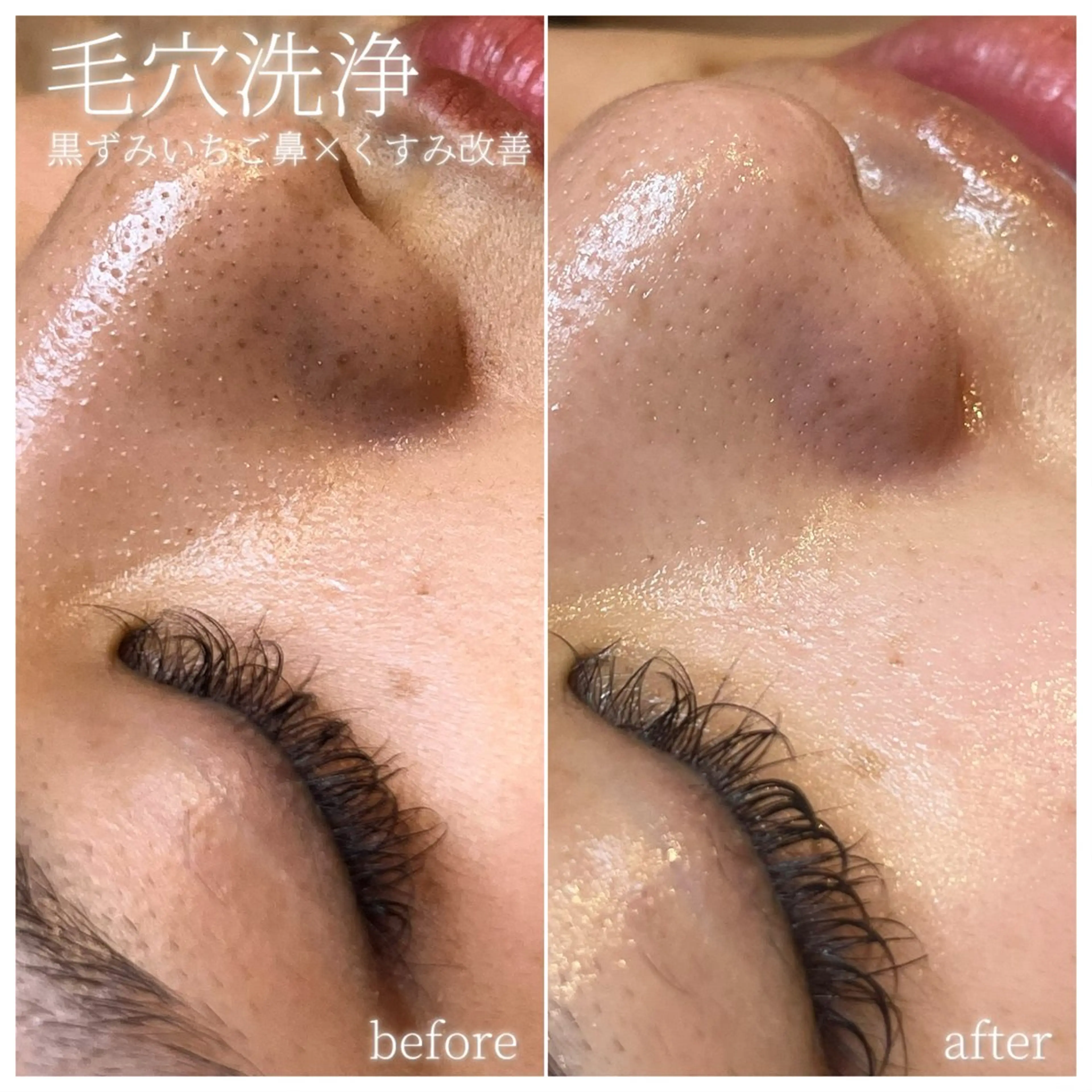 毛穴洗浄👃特殊なローションでしっかり汚れを浮き出して絡めとる🧼✨浮き出しポツポツ汚れ/黒ずみ毛穴/一切にスッキリ😎の写真