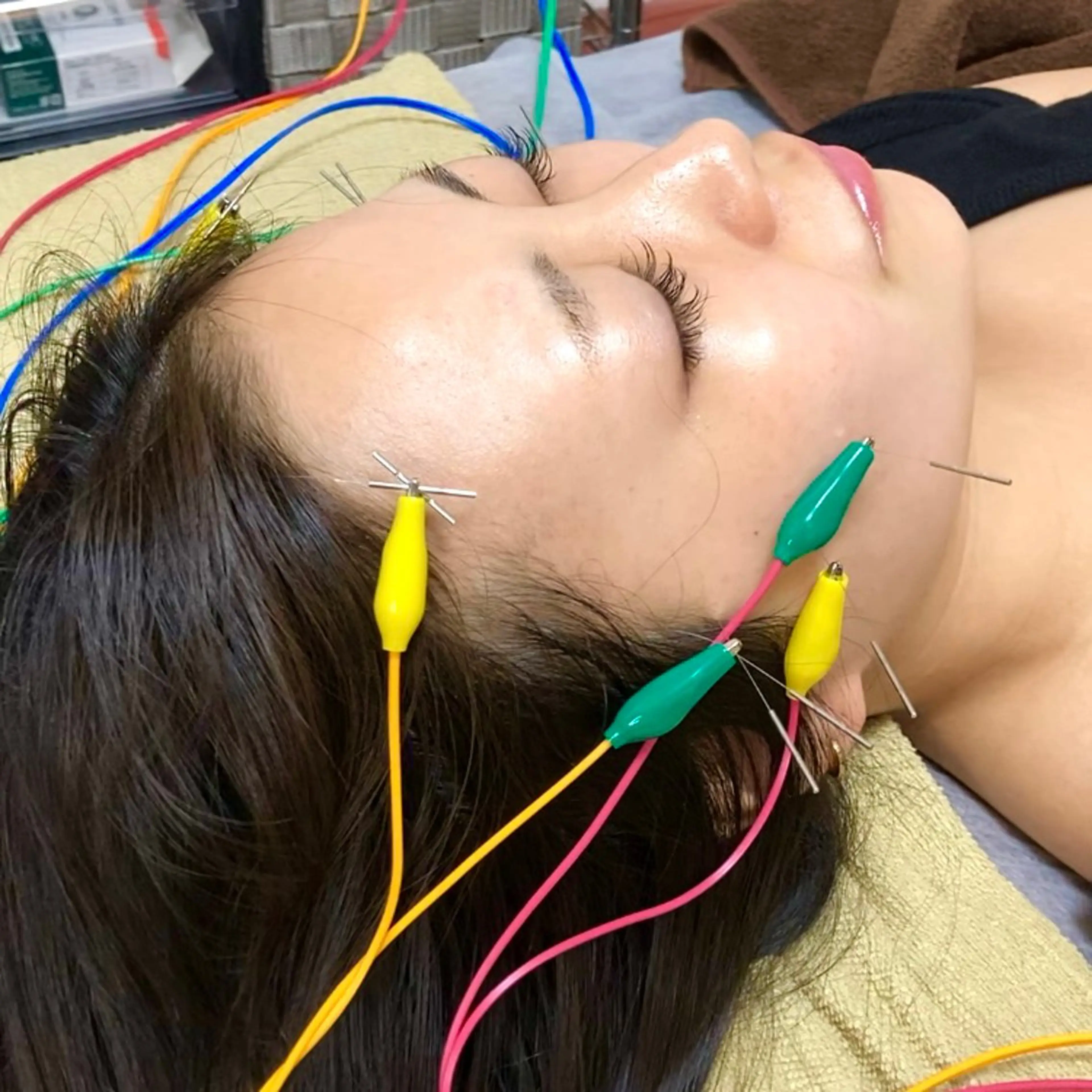 小顔ハーブピーリング 美容鍼/毛穴洗浄のエステ・リラクイメージ