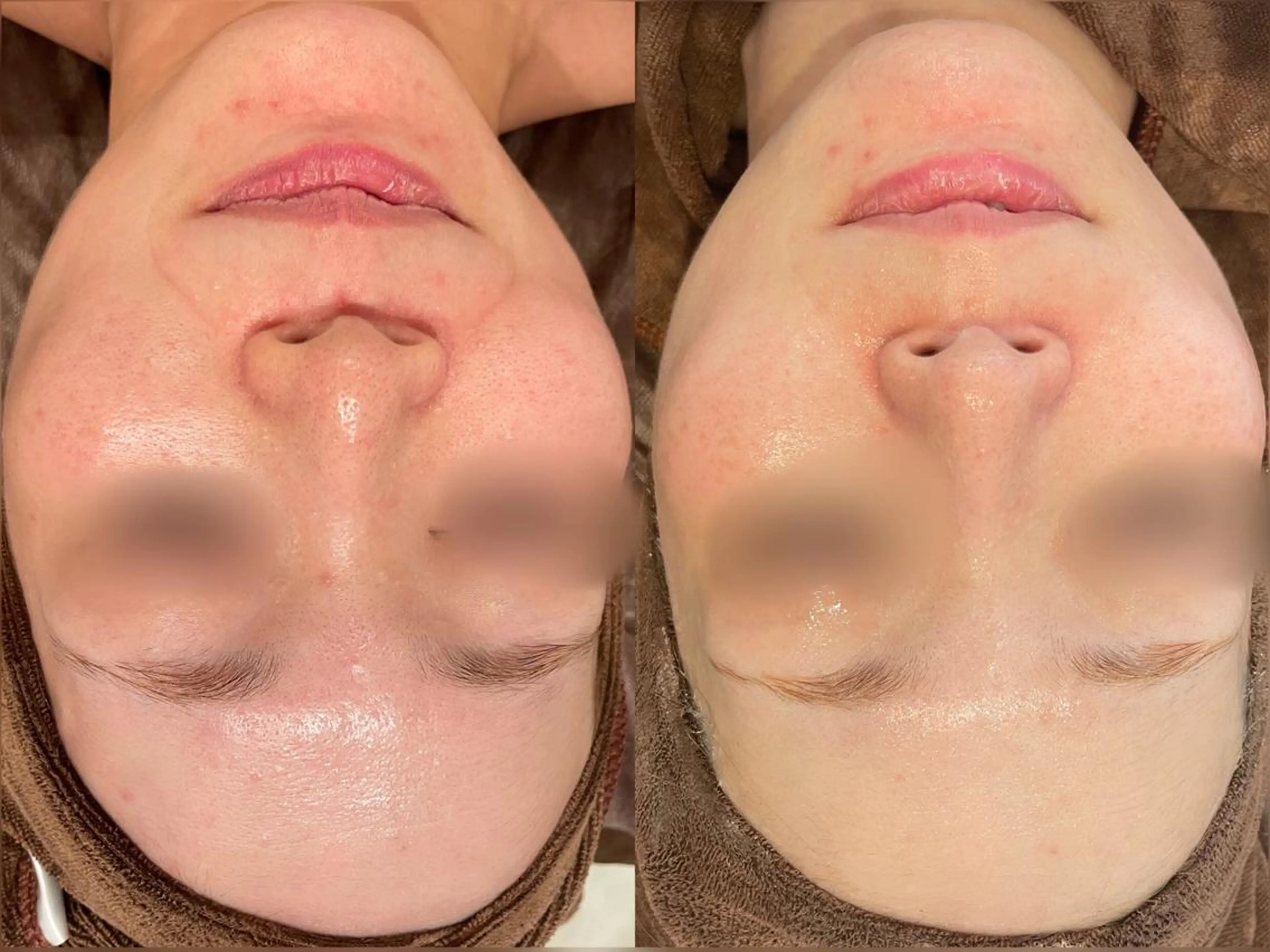 【仕上がり重視】本格毛穴洗浄。ザラつきのないなめらか素肌へ※全顔の写真