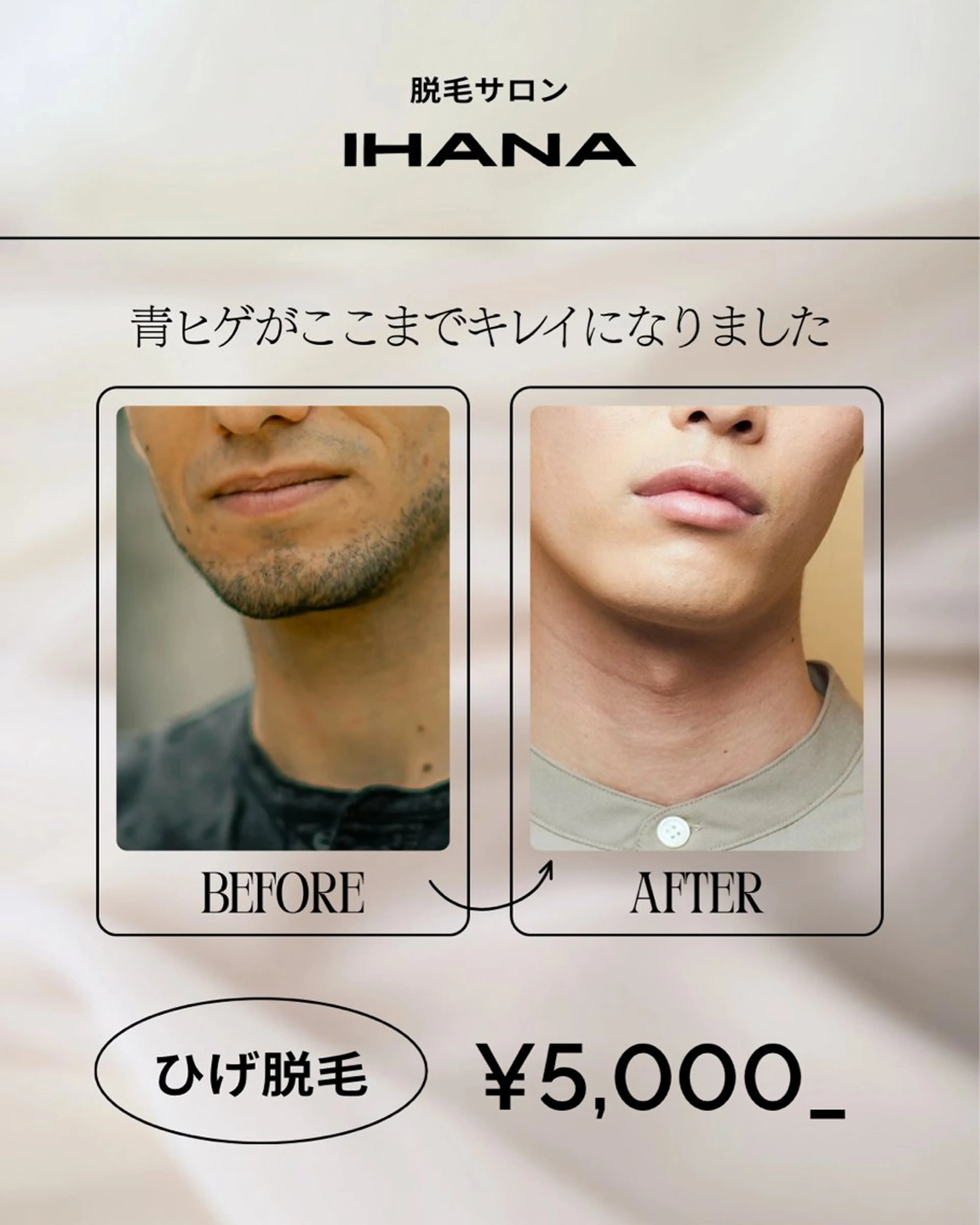 メンズ｜痛みの少ない〝顔＋ヒゲ”脱毛♪の写真