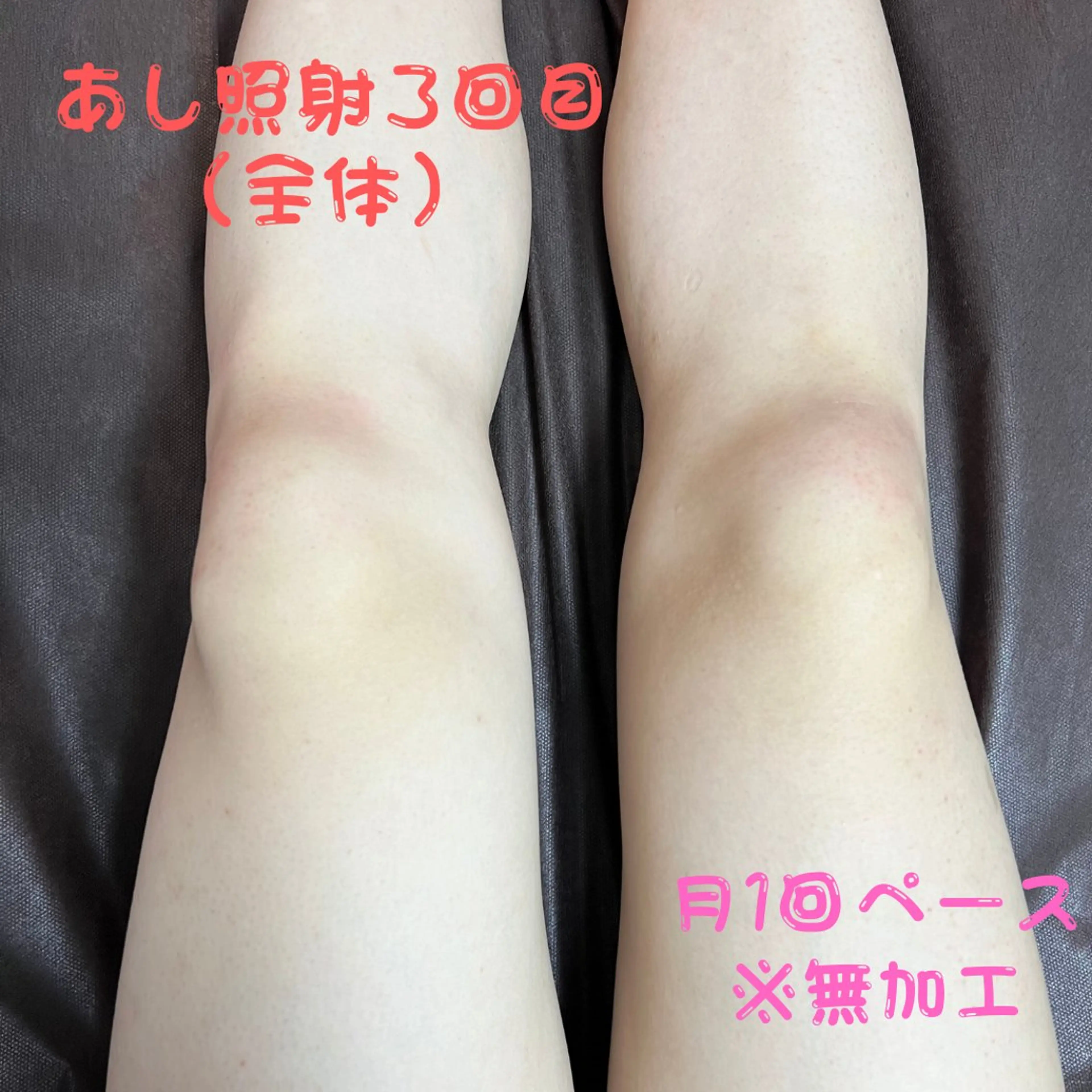 メンズ キッズ 脱毛 メンズ脱毛フェリッセ /男女🆗キッズ🆗のエステ・リラクイメージ