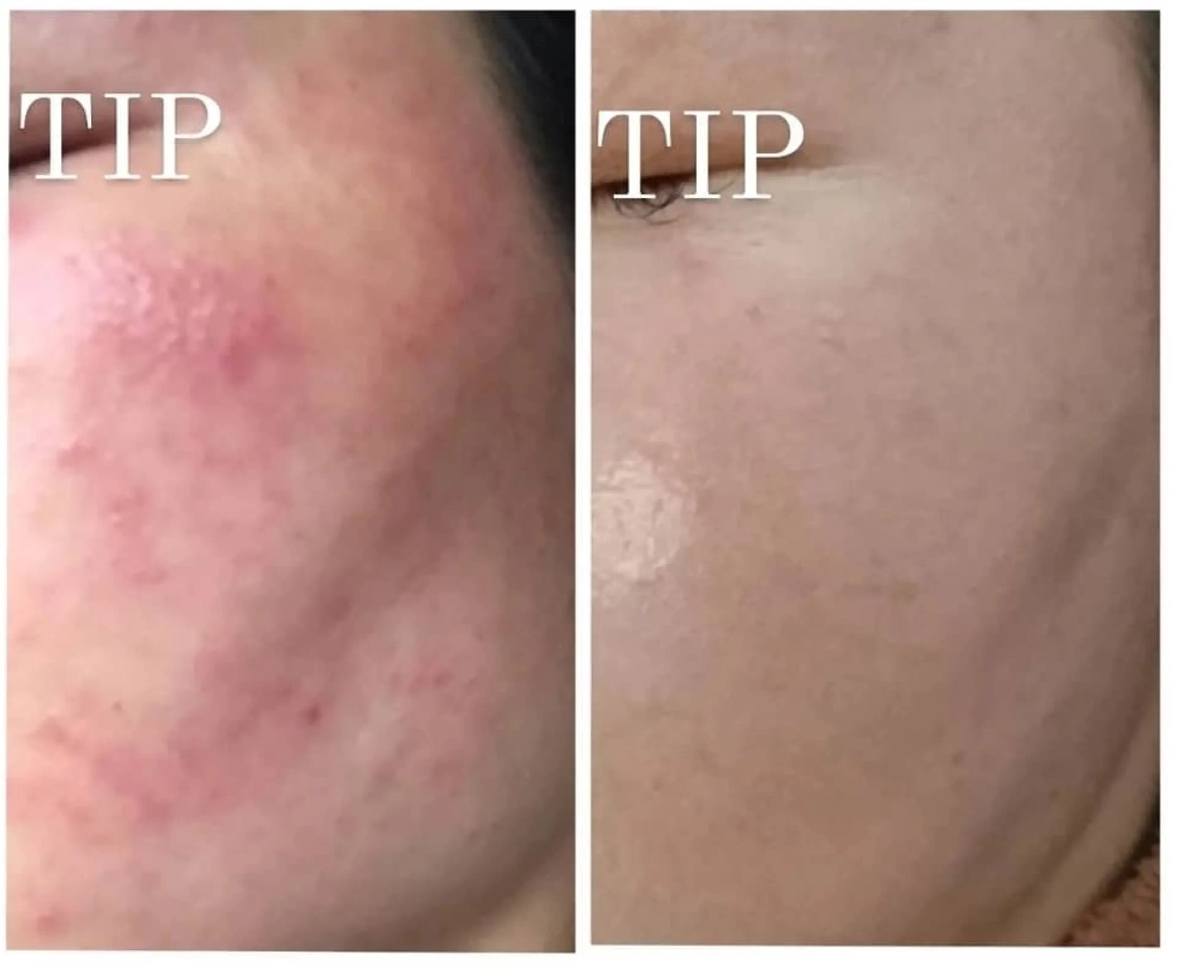 【肌荒れ・ニキビ・ニキビ跡】ソフトハーブ&イオン導入【トーンアップ】の写真