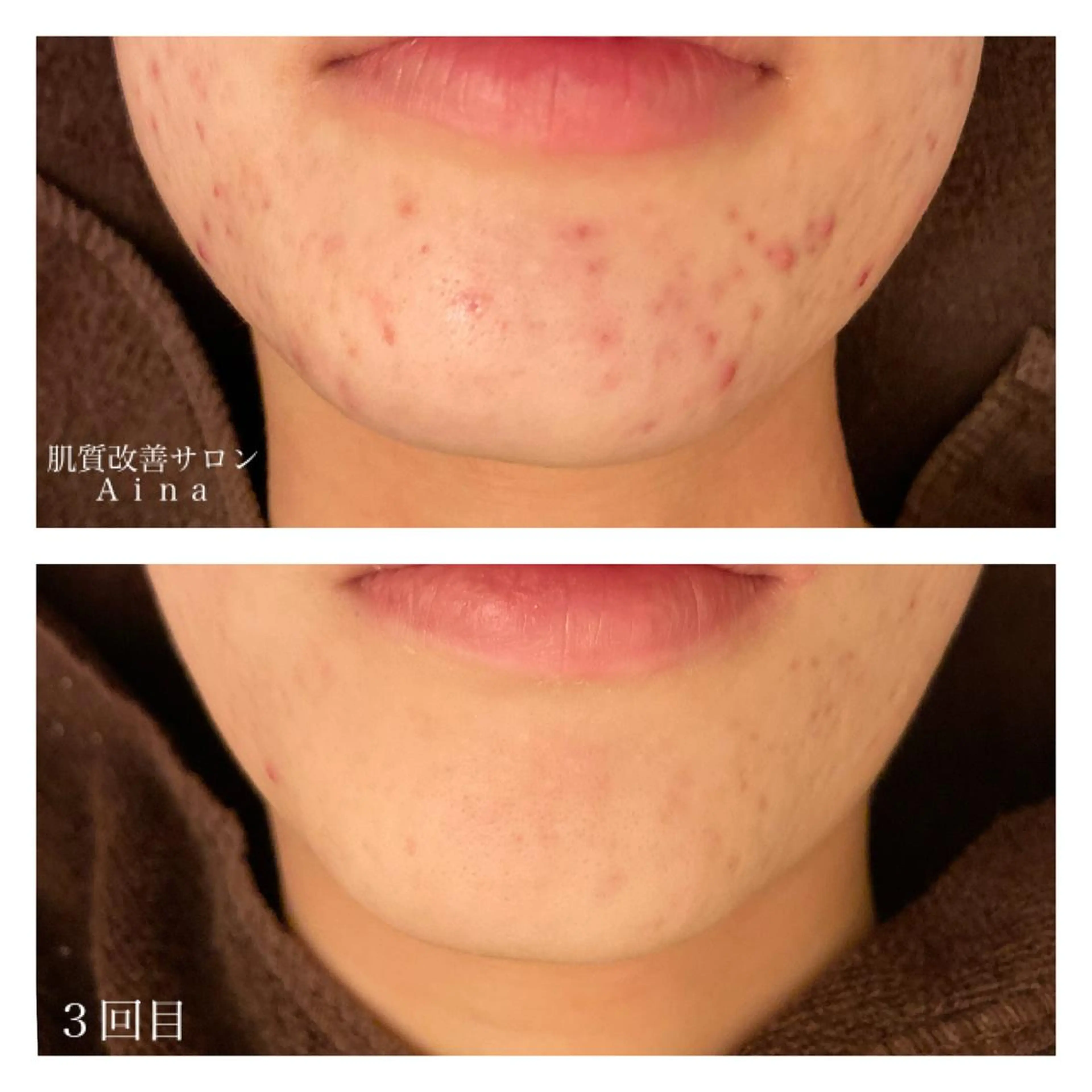 ミディアム カラー パーマ ヘアアレンジ メンズ キッズ ネイル マツエク・マツパ 卒業式のヘアスタイル 卒業式 赤色 エステ リラク ニキビ跡専門サロン Ａｉｎａのエステ・リラクイメージ