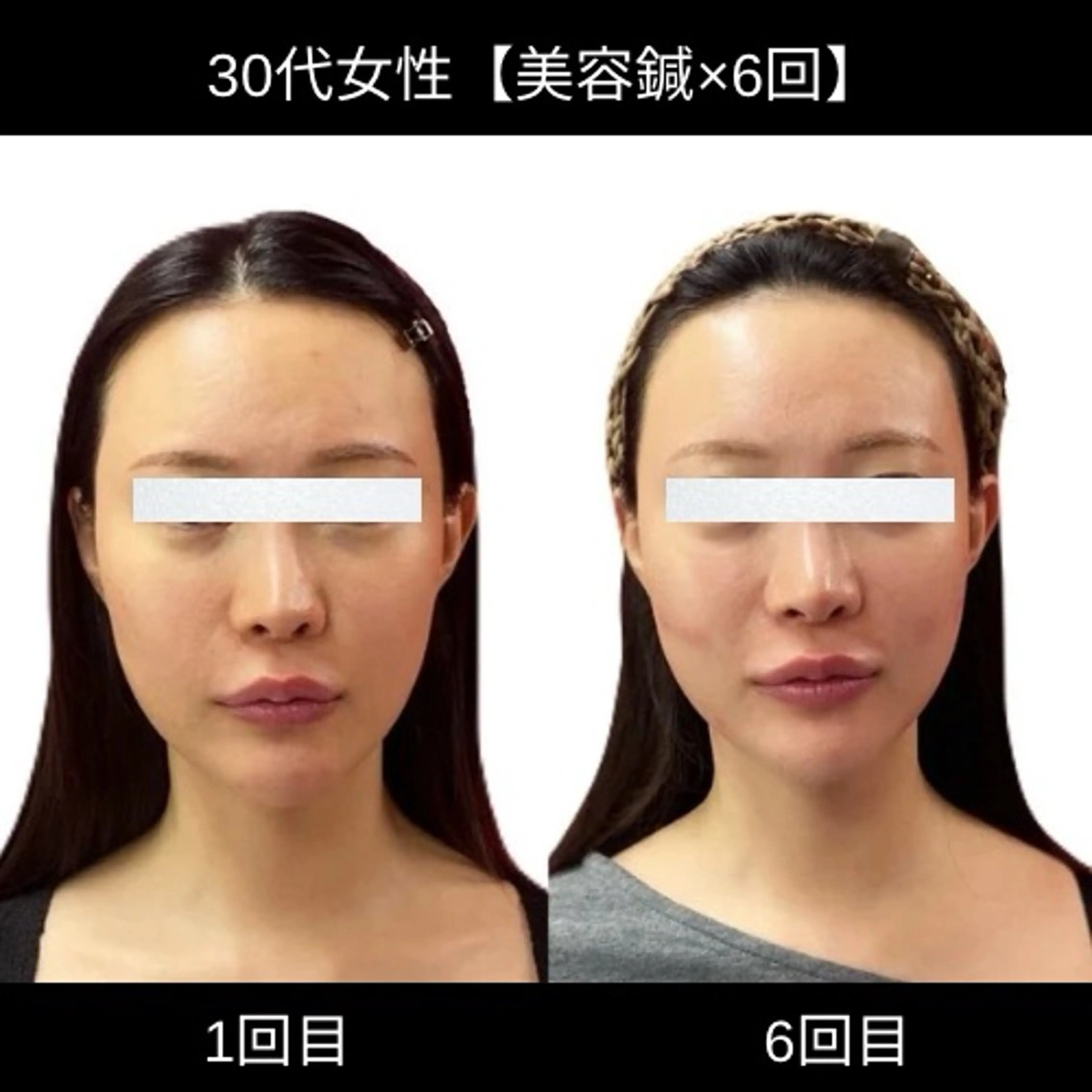 美容鍼 IKEZAKIのエステ・リラクイメージ