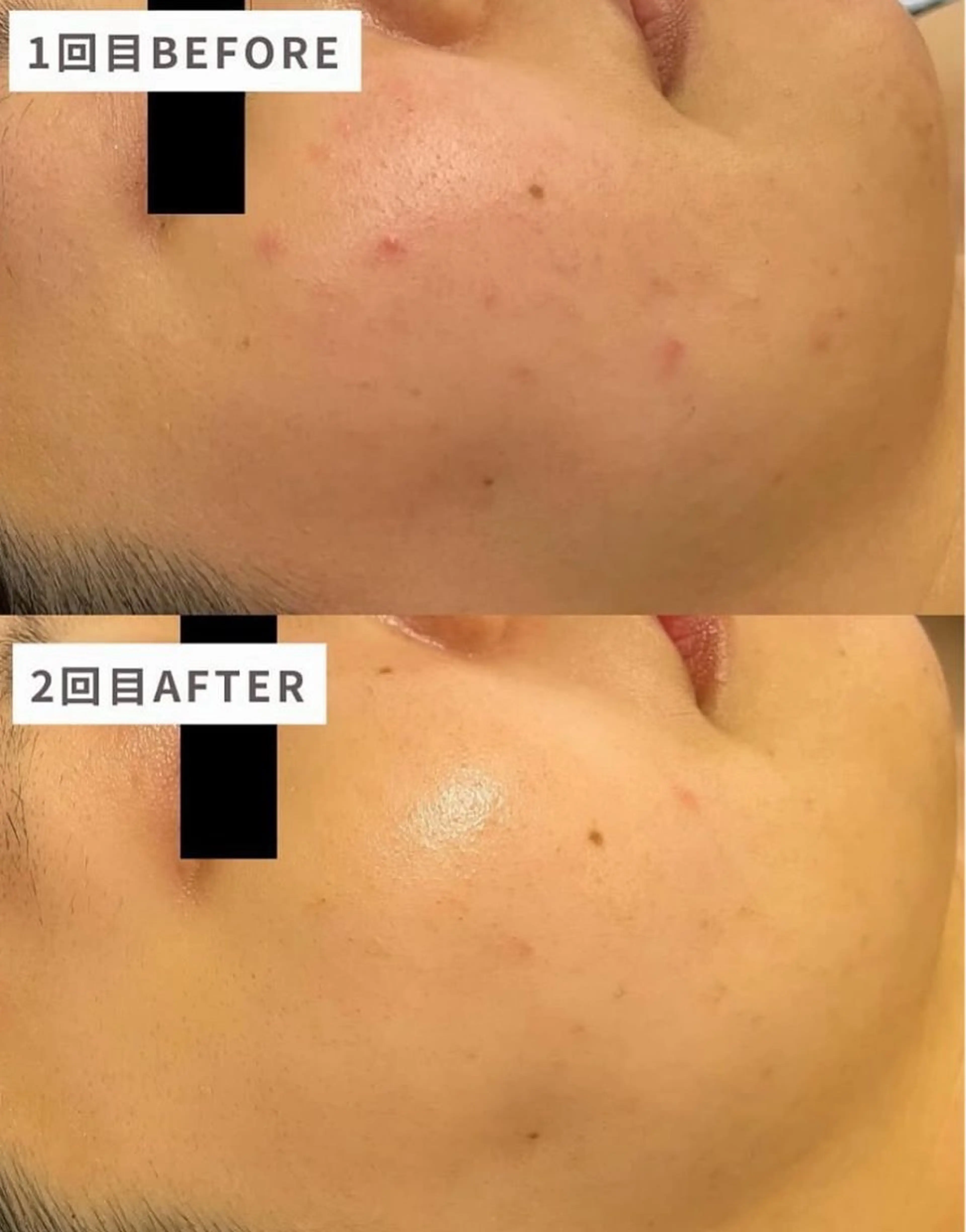 2回試せる🎶集中ニキビケア！【REVIハーブピーリング2回分セット】短期間で改善の写真