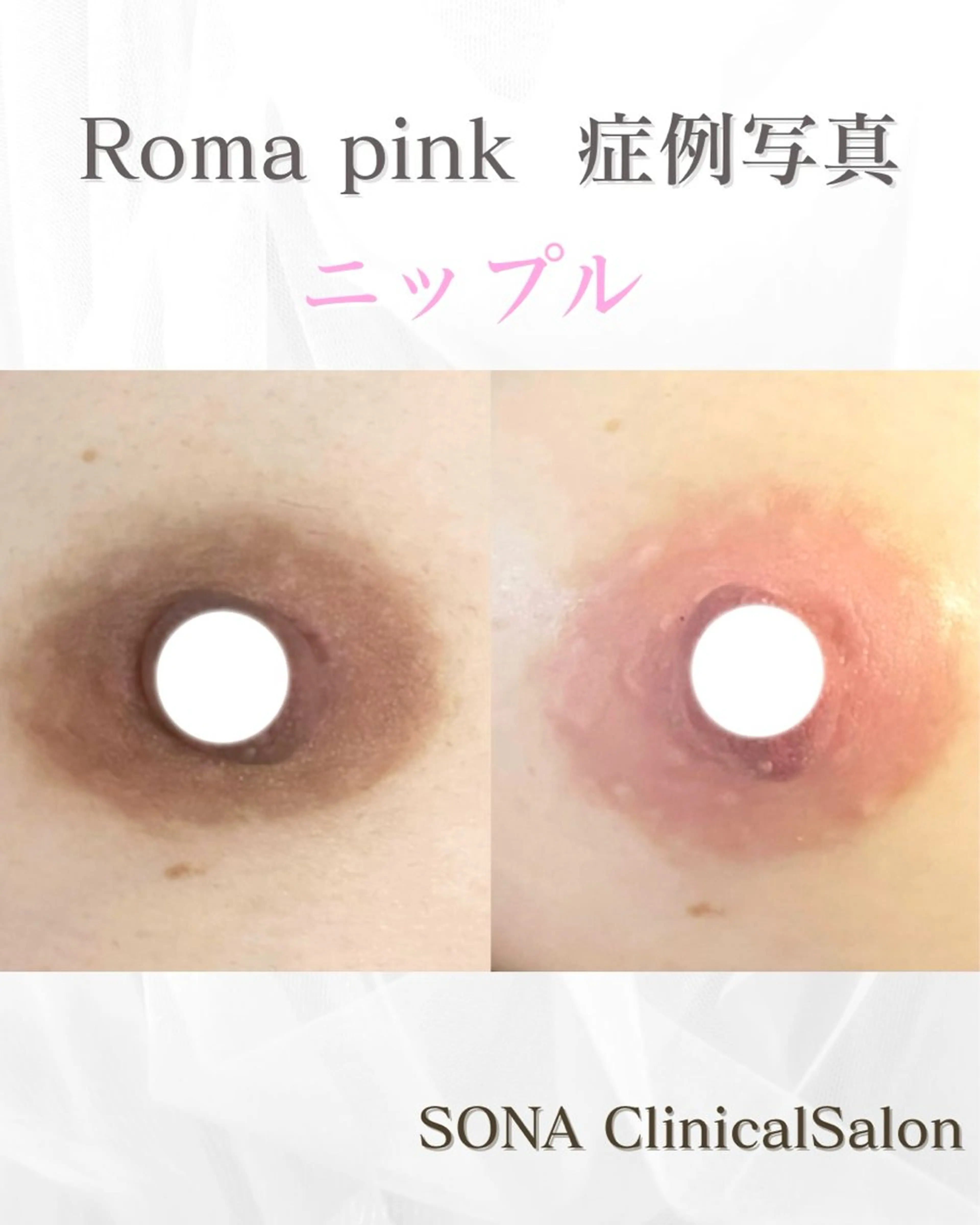 【バストの黒ずみをピンクに🎀】ローマピンクのバスト希望の方はこちら♪の写真