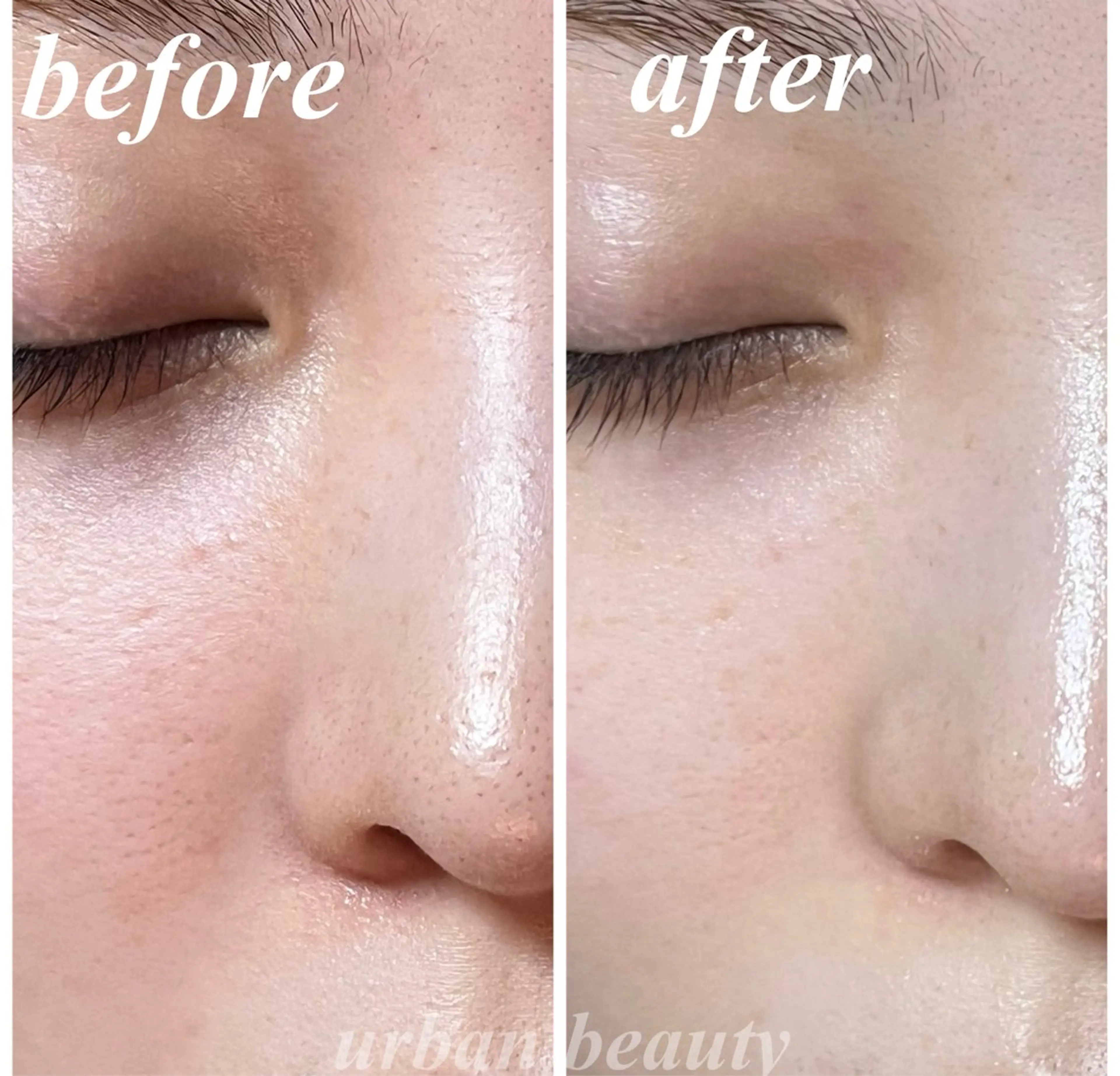 ⭐️ご新規様限定⭐️毛穴エクストラクション70分(小鼻•小鼻周りのみ)の写真