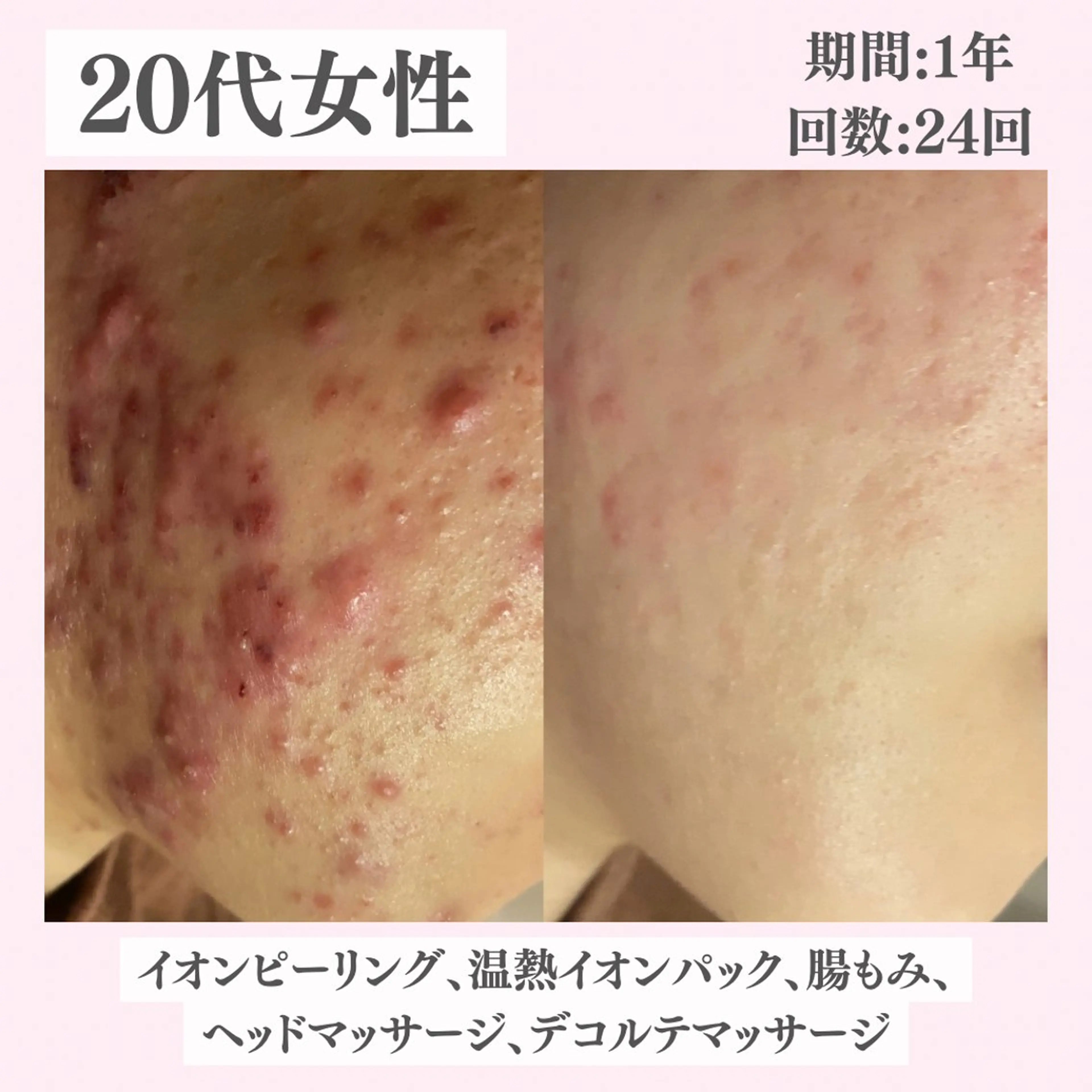 エステ リラク ニキビ・肌質改善専門 ♡人生が変わるサロンのエステ・リラクイメージ