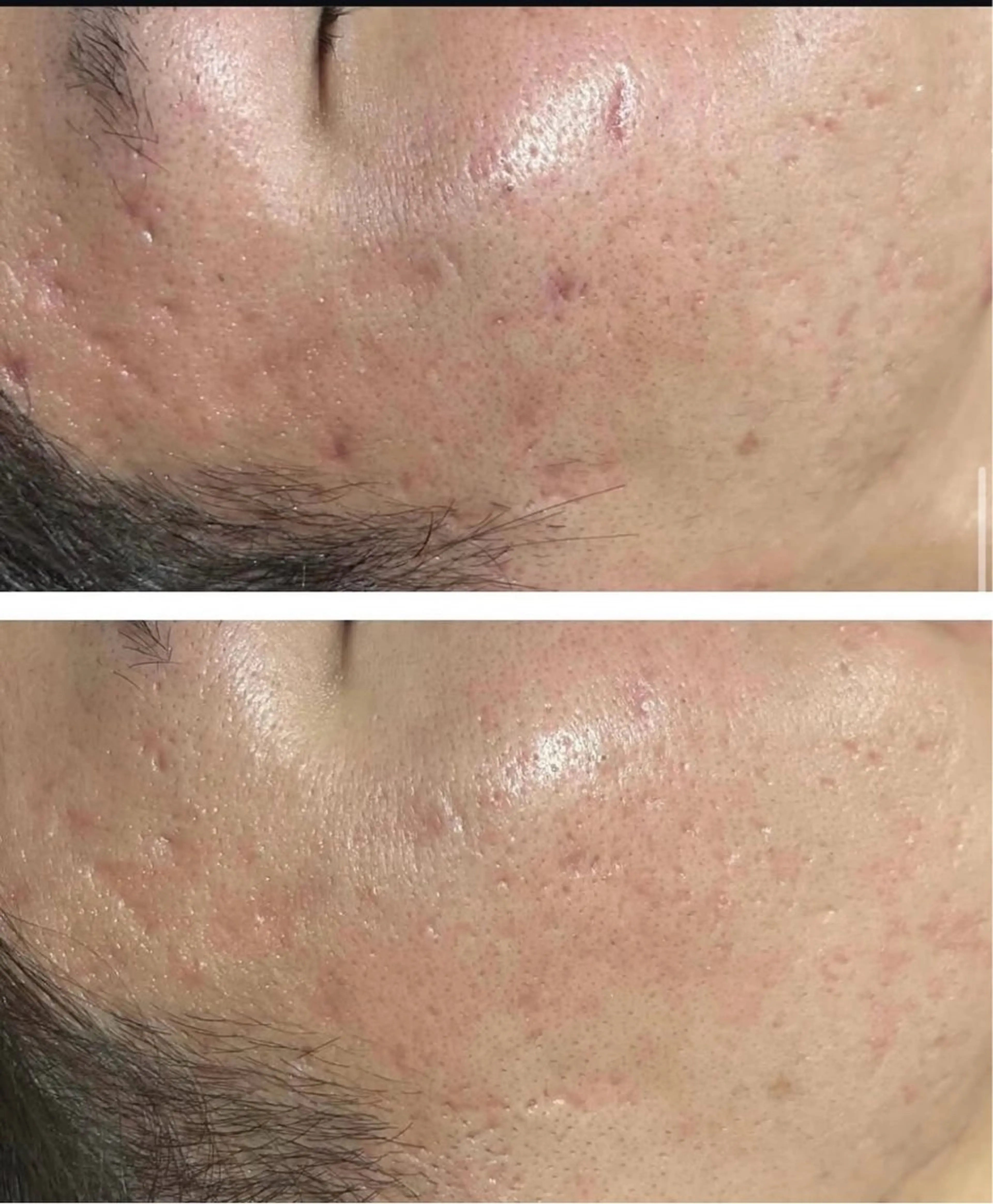 【剥離なし】顔🌿ハーブピーリングの写真