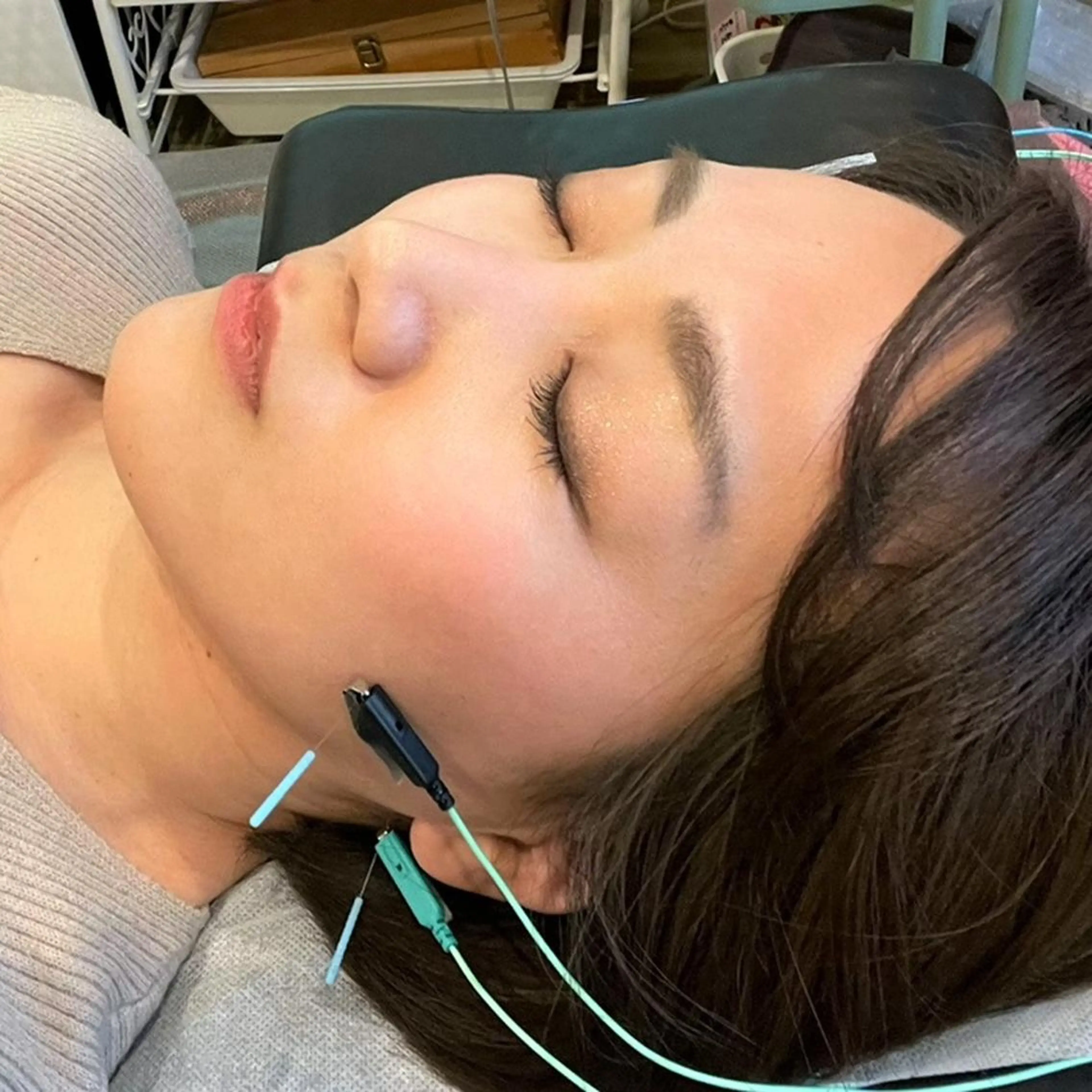 小顔・たるみの美容鍼の写真