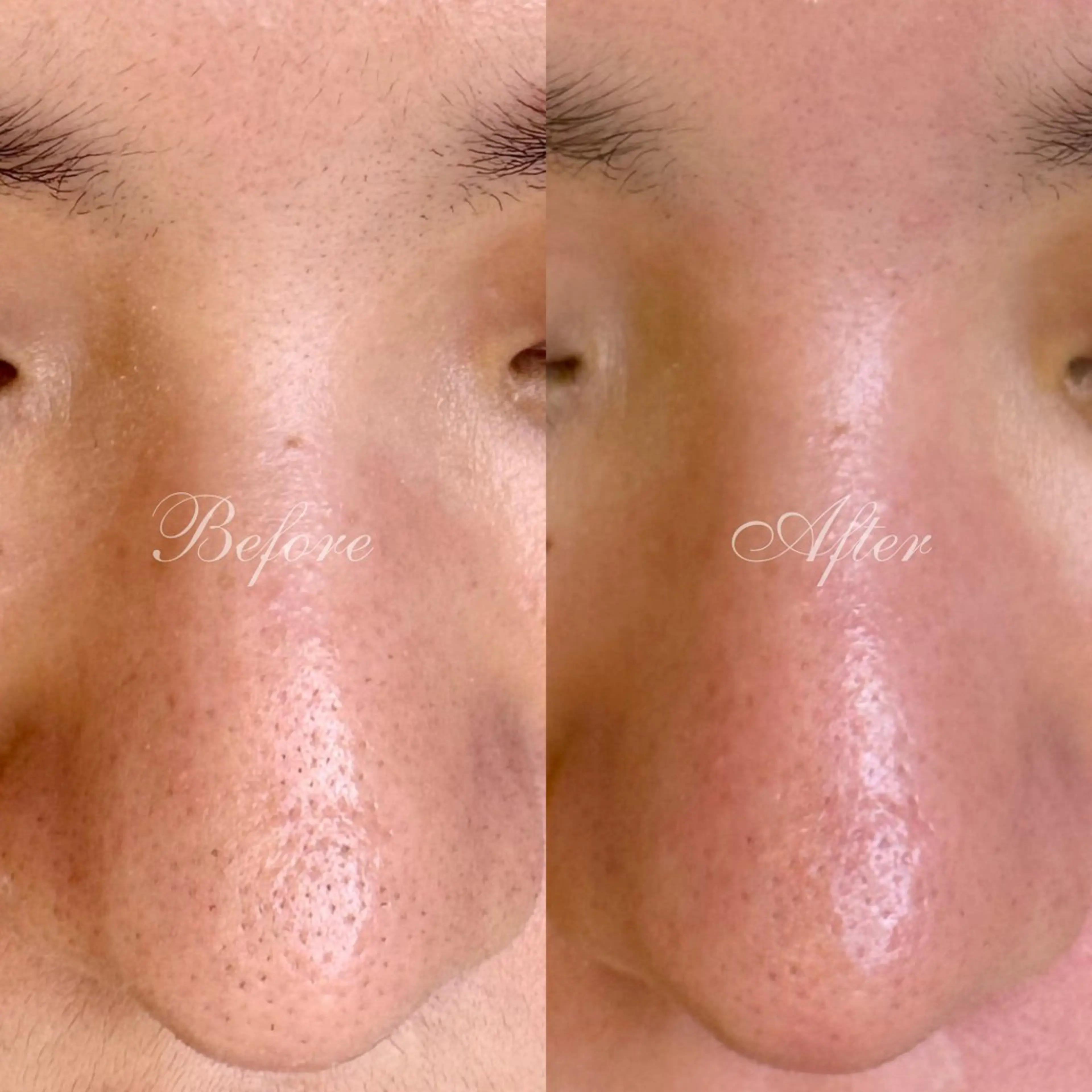 フェイシャルワックス+肌再生パックの写真