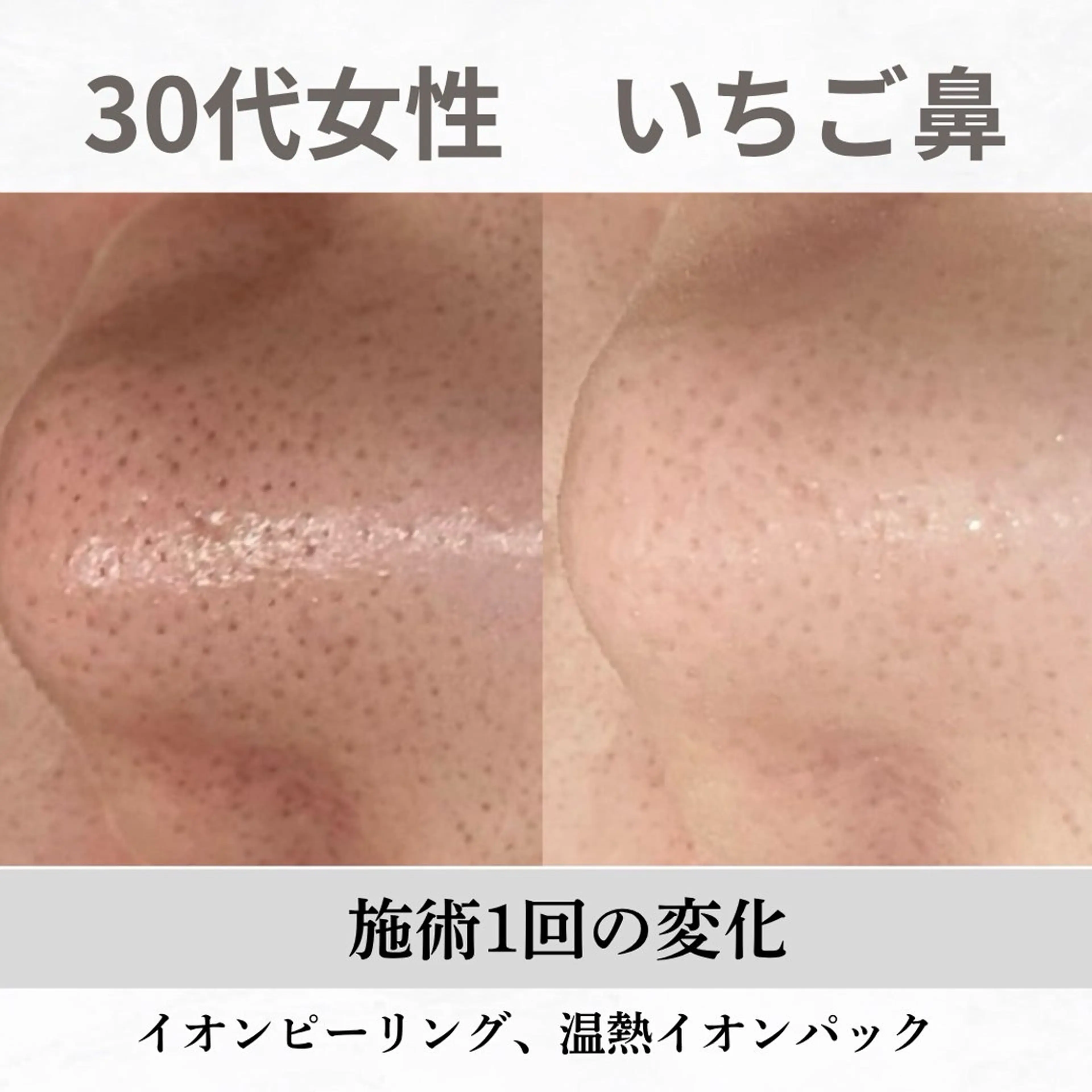 重度ニキビ専門🌷 ダウンタイムなしのエステ・リラクイメージ