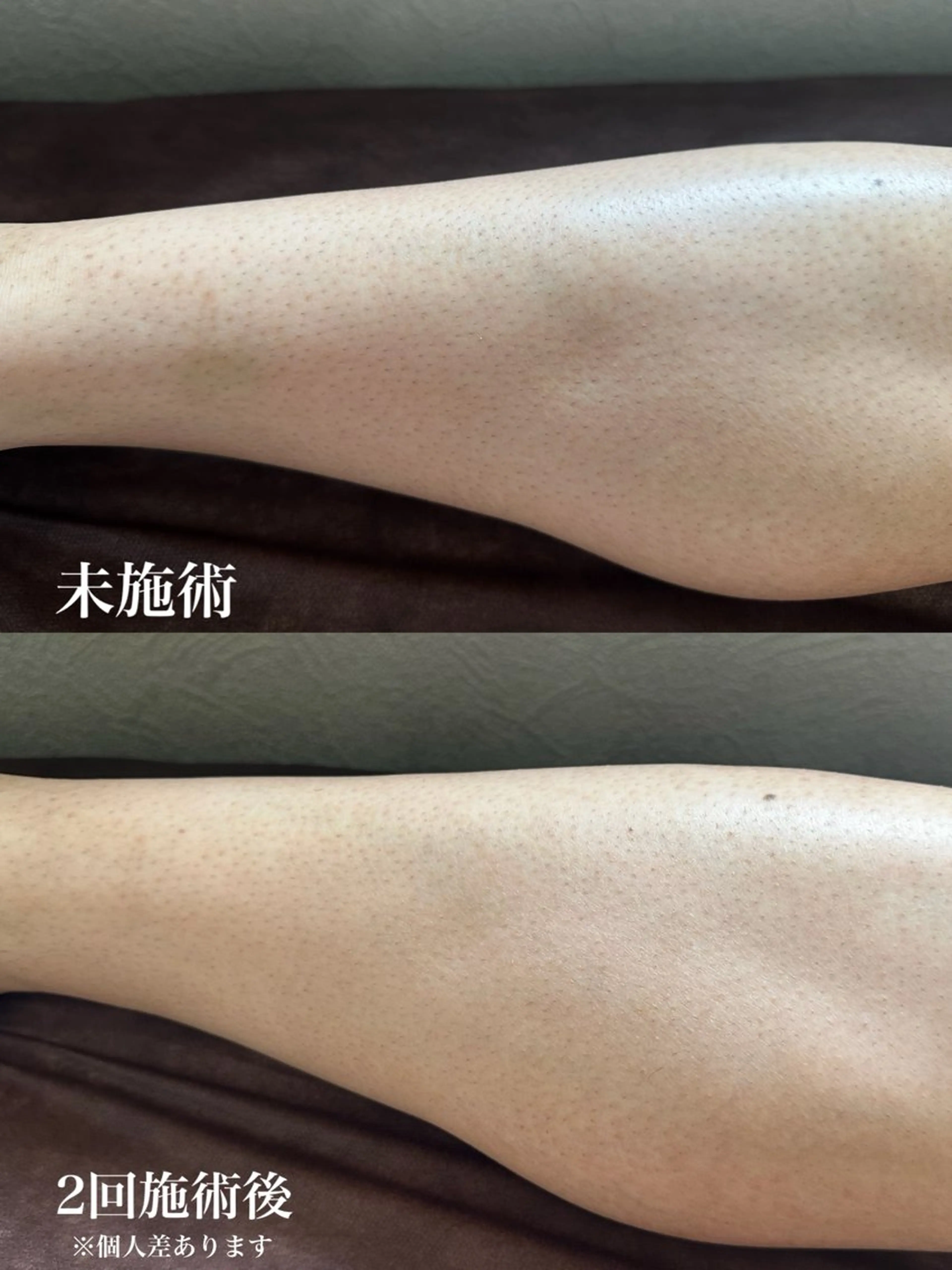 メンズ両足全体脱毛の写真