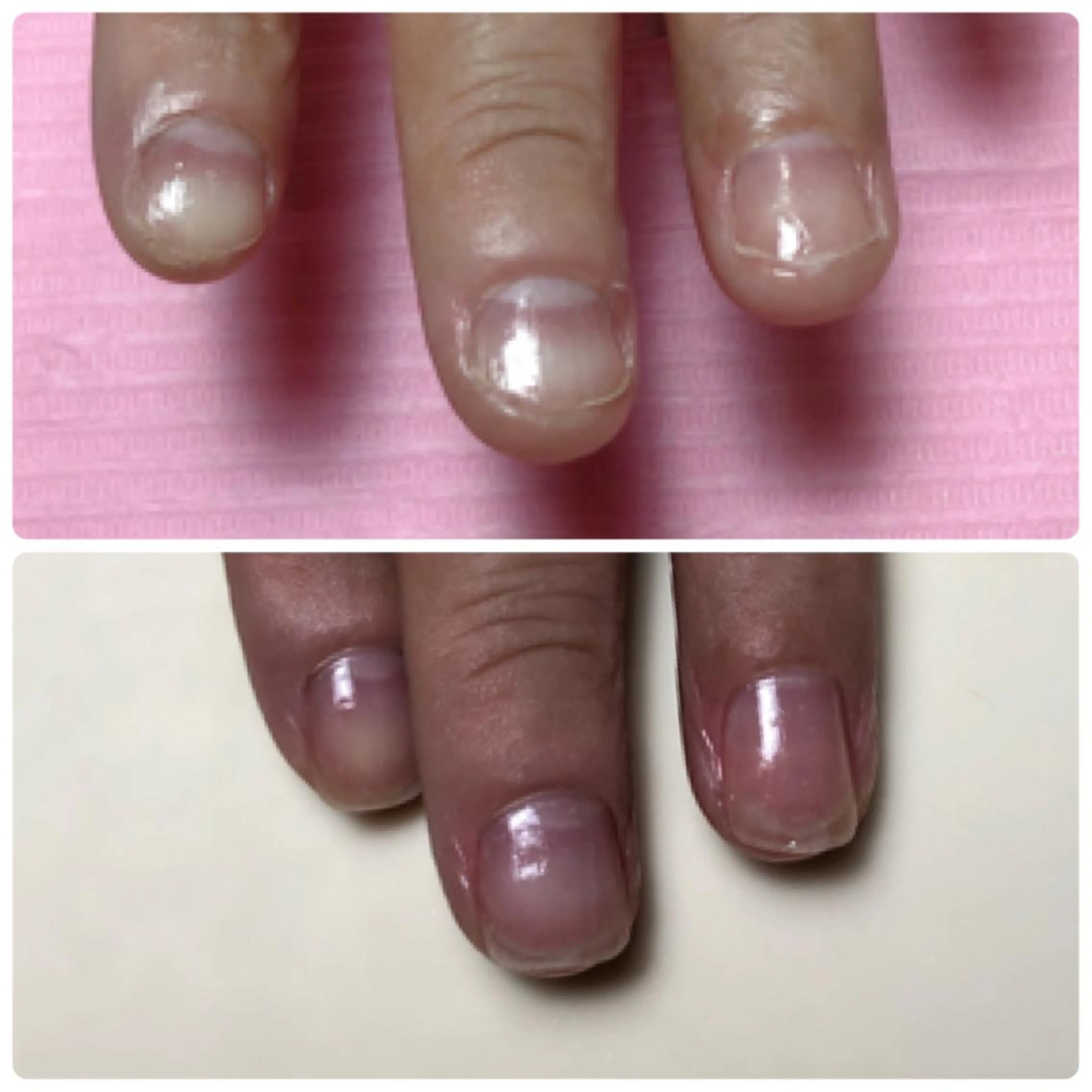 ネイル Nail ビ爪のネイルデザイン