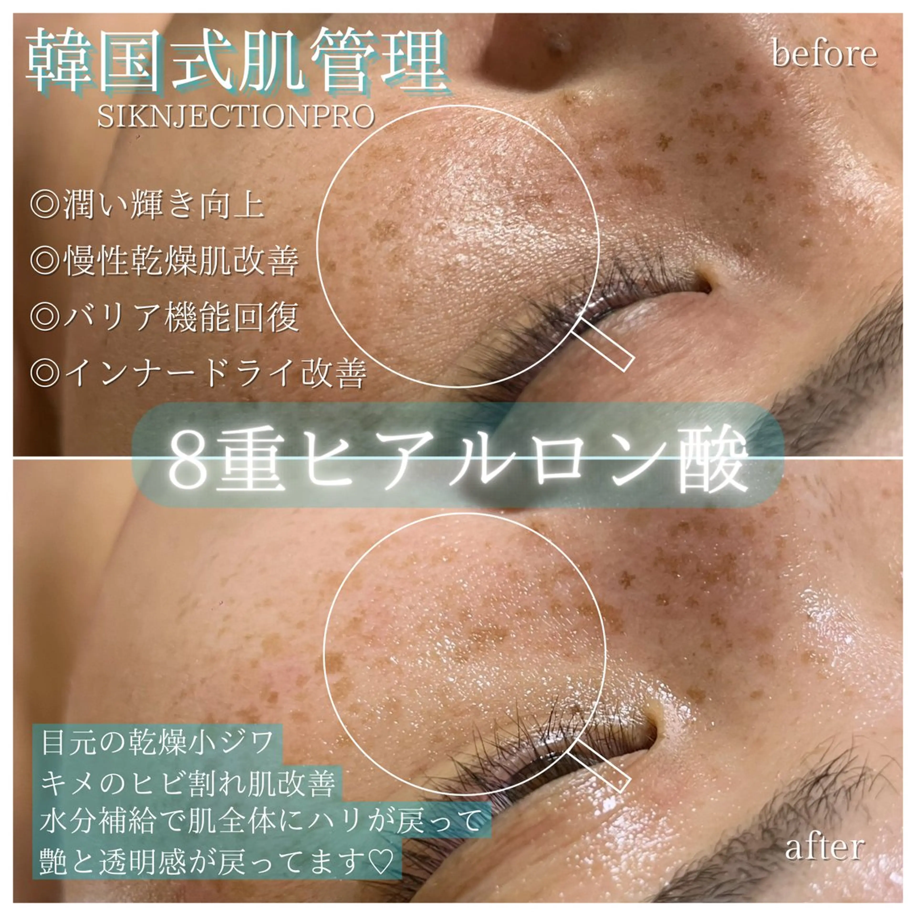 韓国エステ式リジュラン💉🇰🇷スキンジェクション（ハイアルティブ🩵）初のフィラートリートメント艶肌&乾燥にはこれの写真