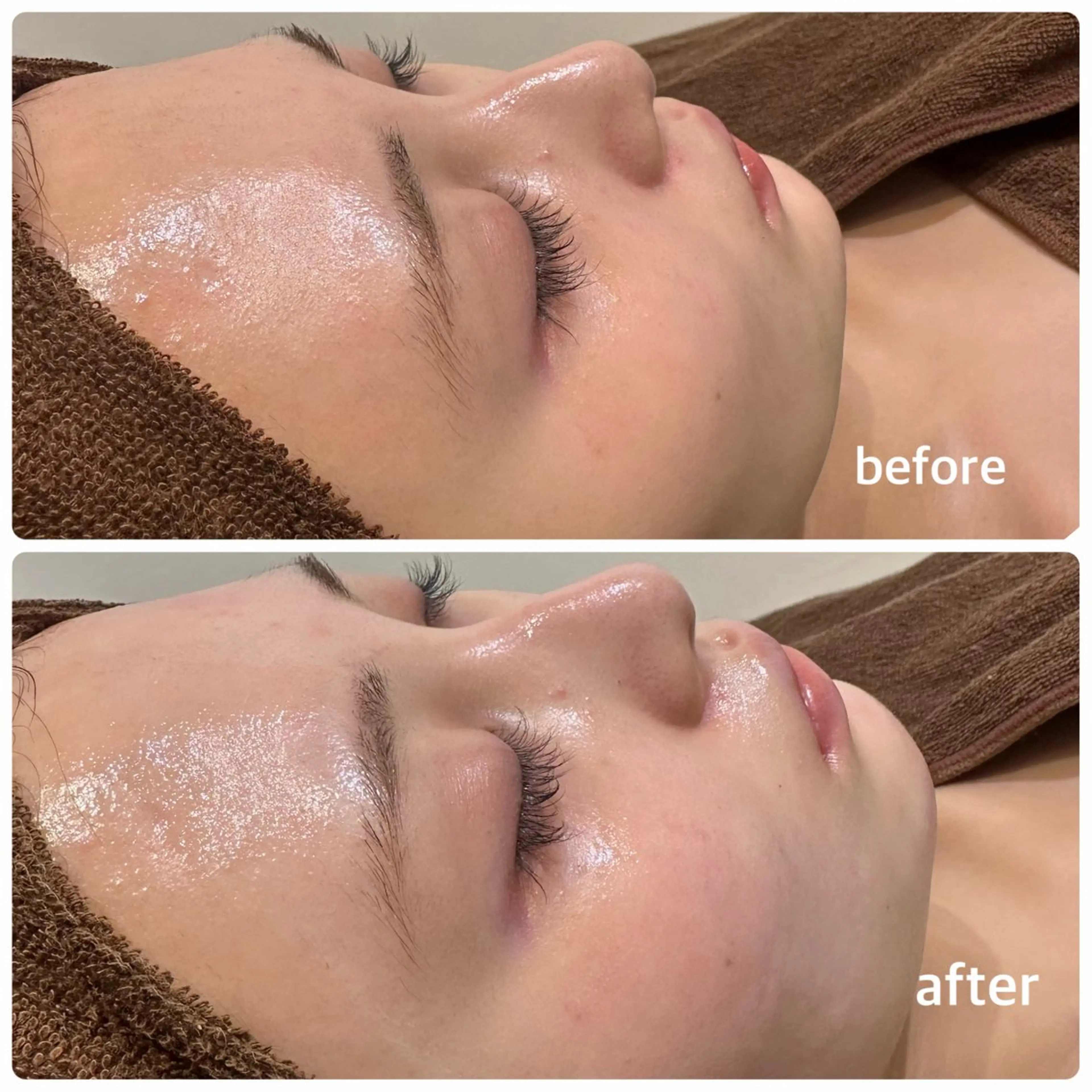 毛穴改善ハーブピーリングMinouミヌ心斎橋所属・今西 彩夢 Minou心斎橋店のエステ・リラクイメージ