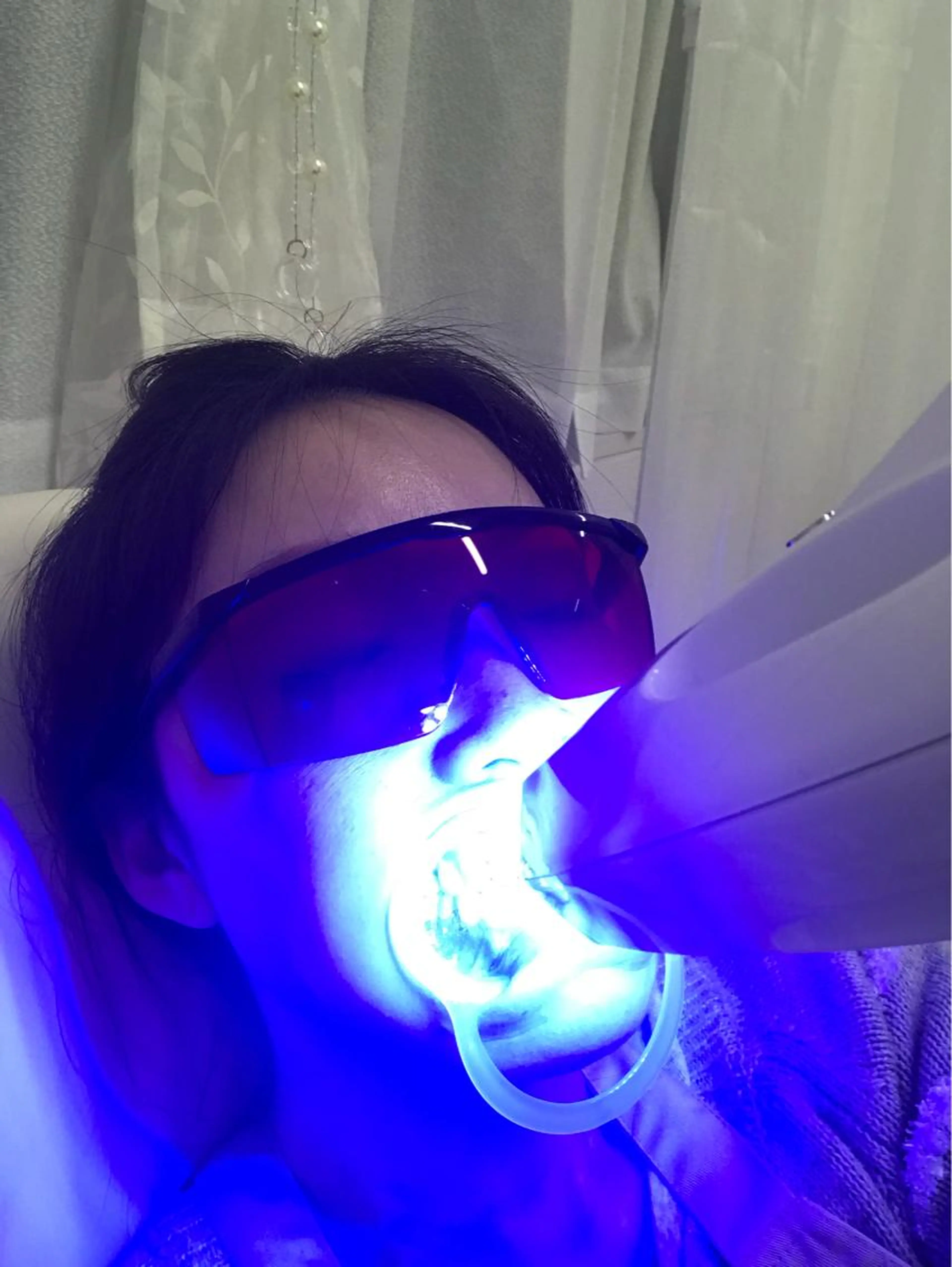 【歯のホワイトニング🦷✨】まずはお試し♡1セット（8分✖️2回）の写真