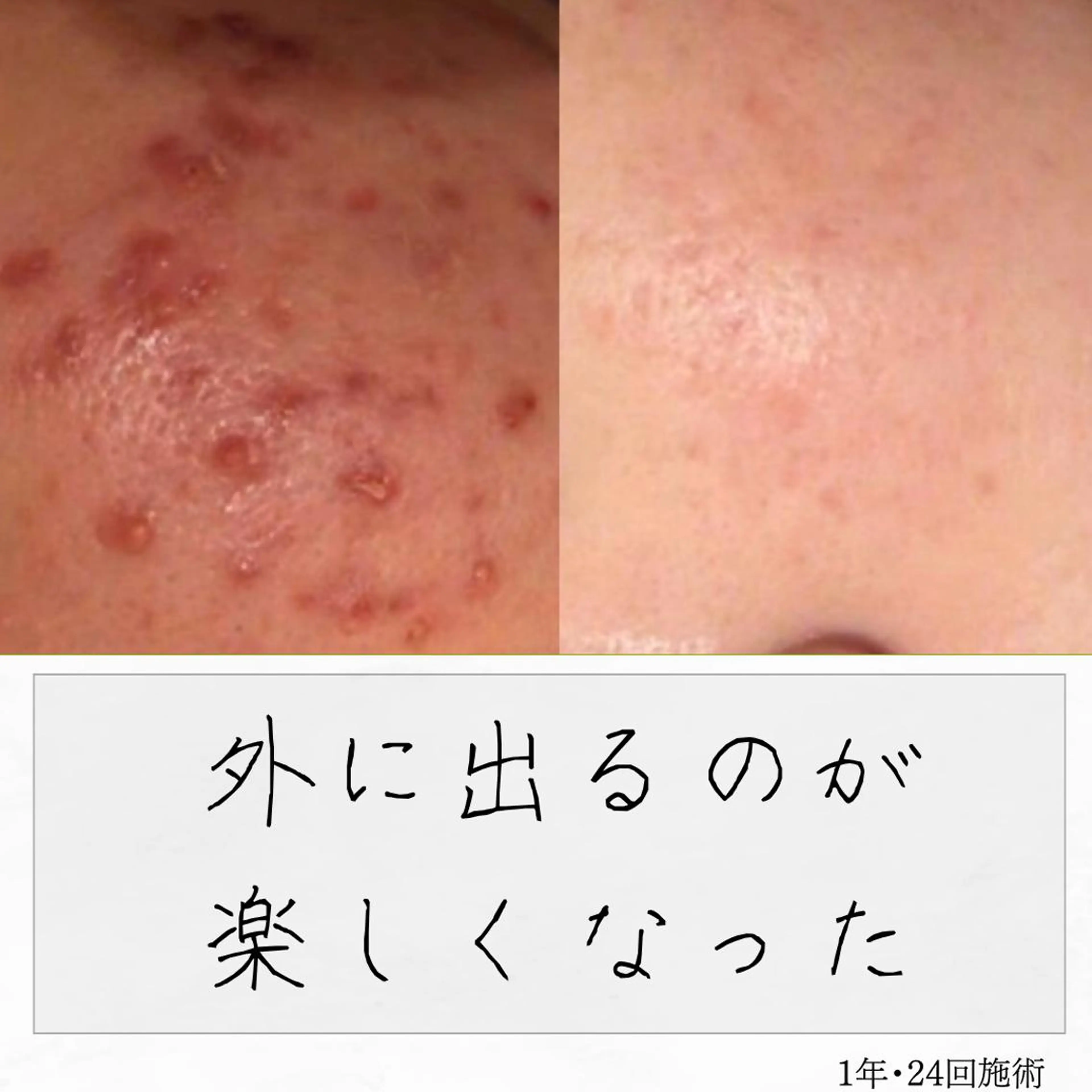 ニキビ経験者が施術 する専門サロン🌻のエステ・リラクイメージ