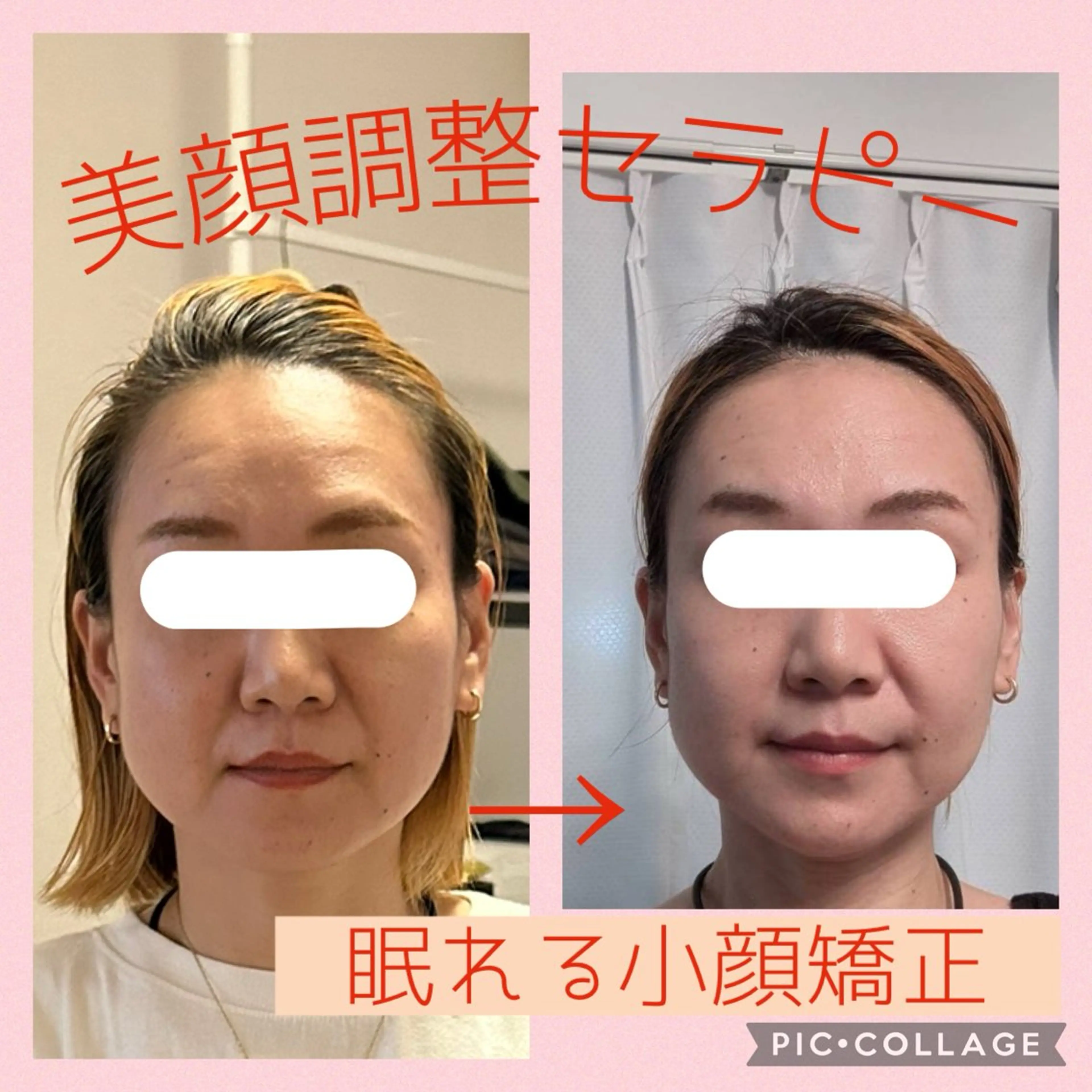 美顔調整セラピー（無痛小顔矯正）の写真