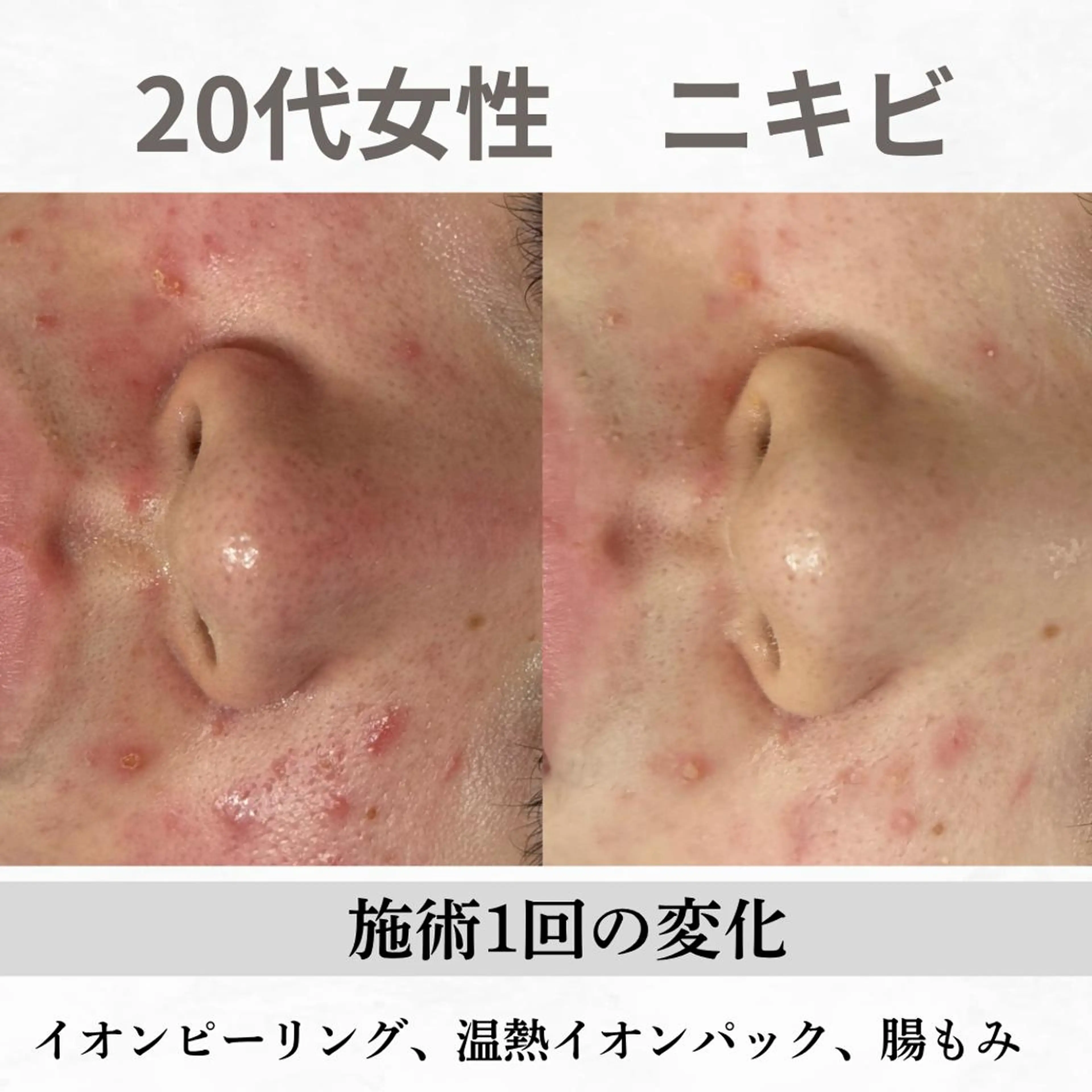 重度ニキビ専門🌷 ダウンタイムなしのエステ・リラクイメージ