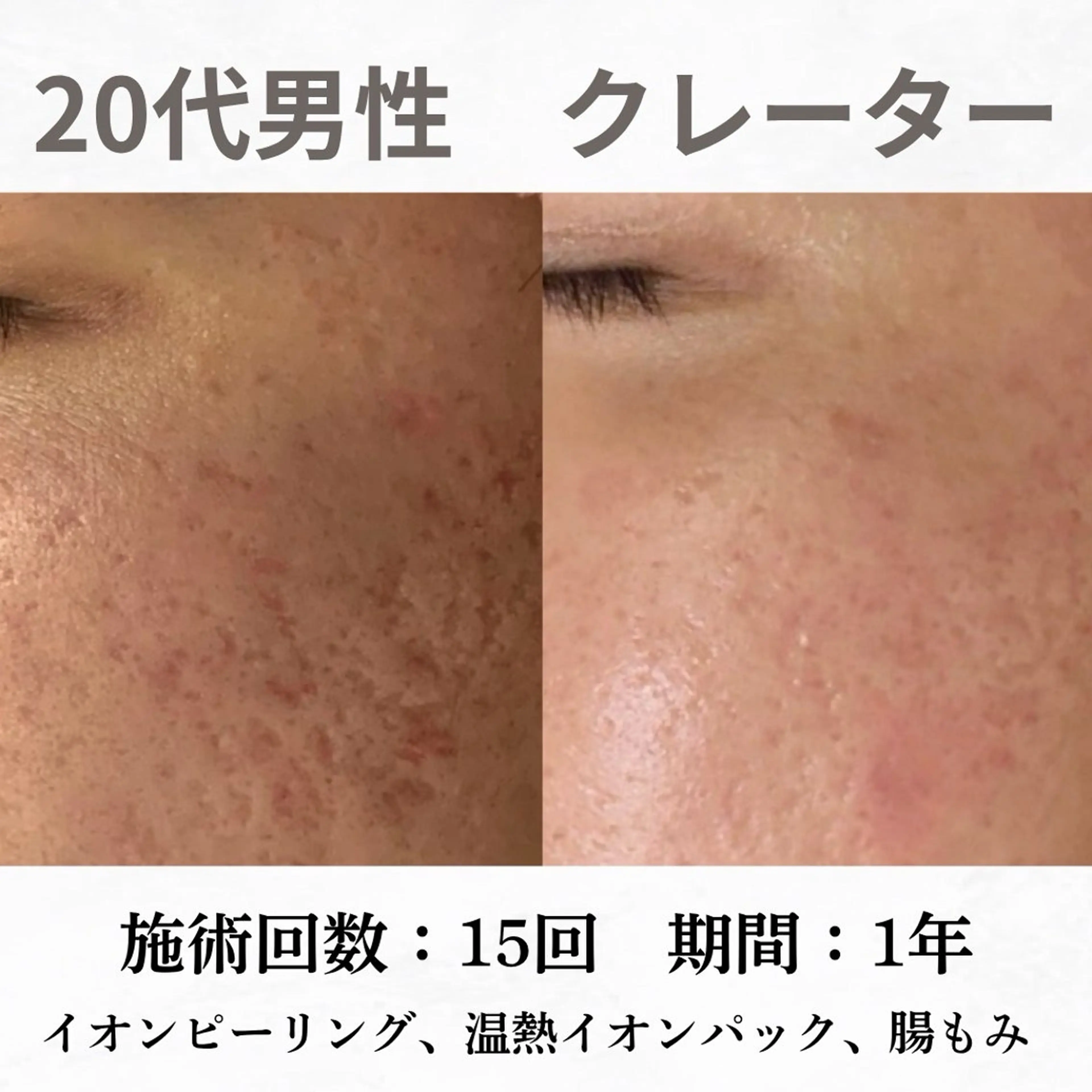 重度ニキビ専門🌷 ダウンタイムなしのエステ・リラクイメージ