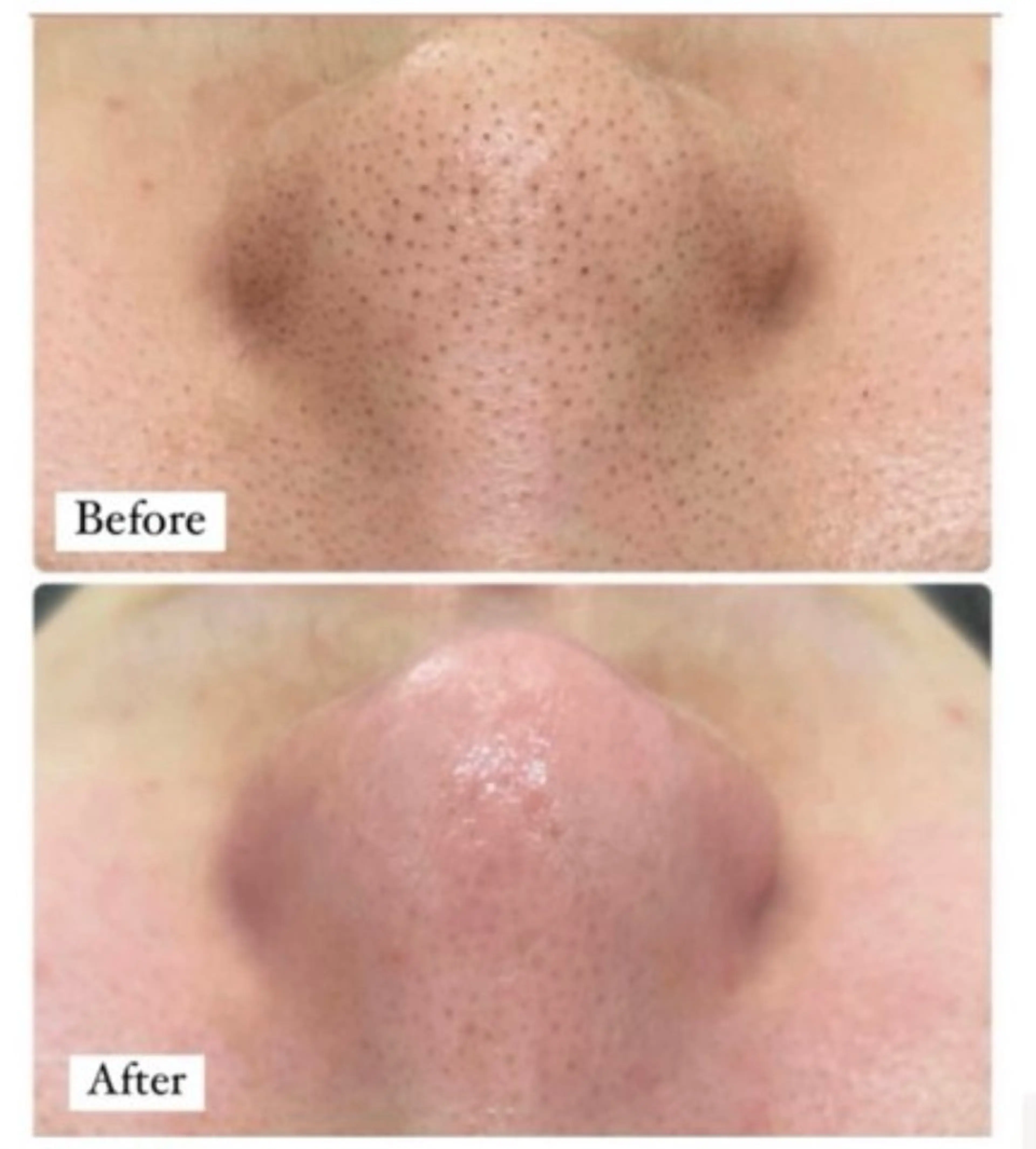 毛穴エクストラクション×クリスティーナ肌質別栄養マスク+ヘッドマッサージ付　¥11500→の写真