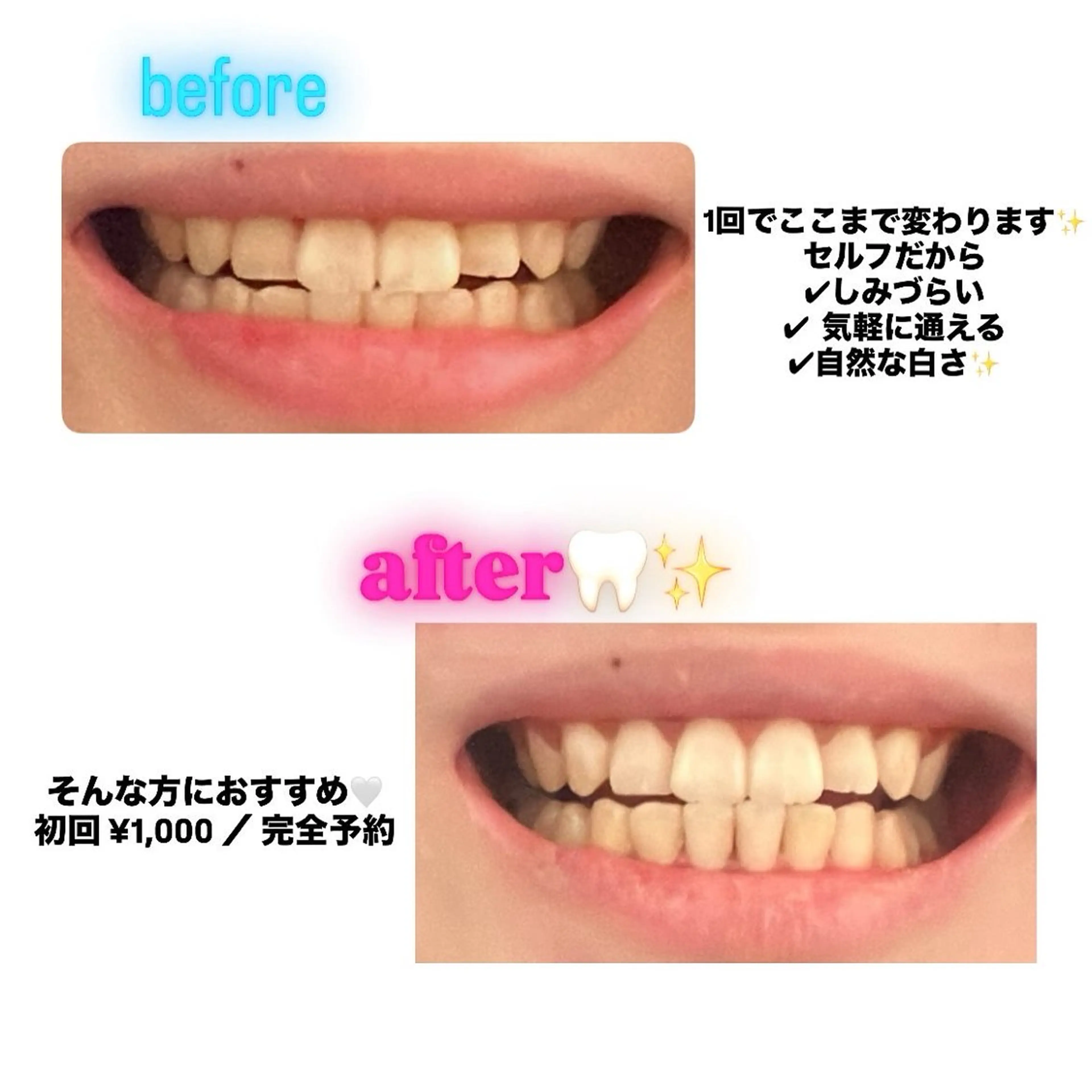 セルフホワイトニング スタンダードコースの写真