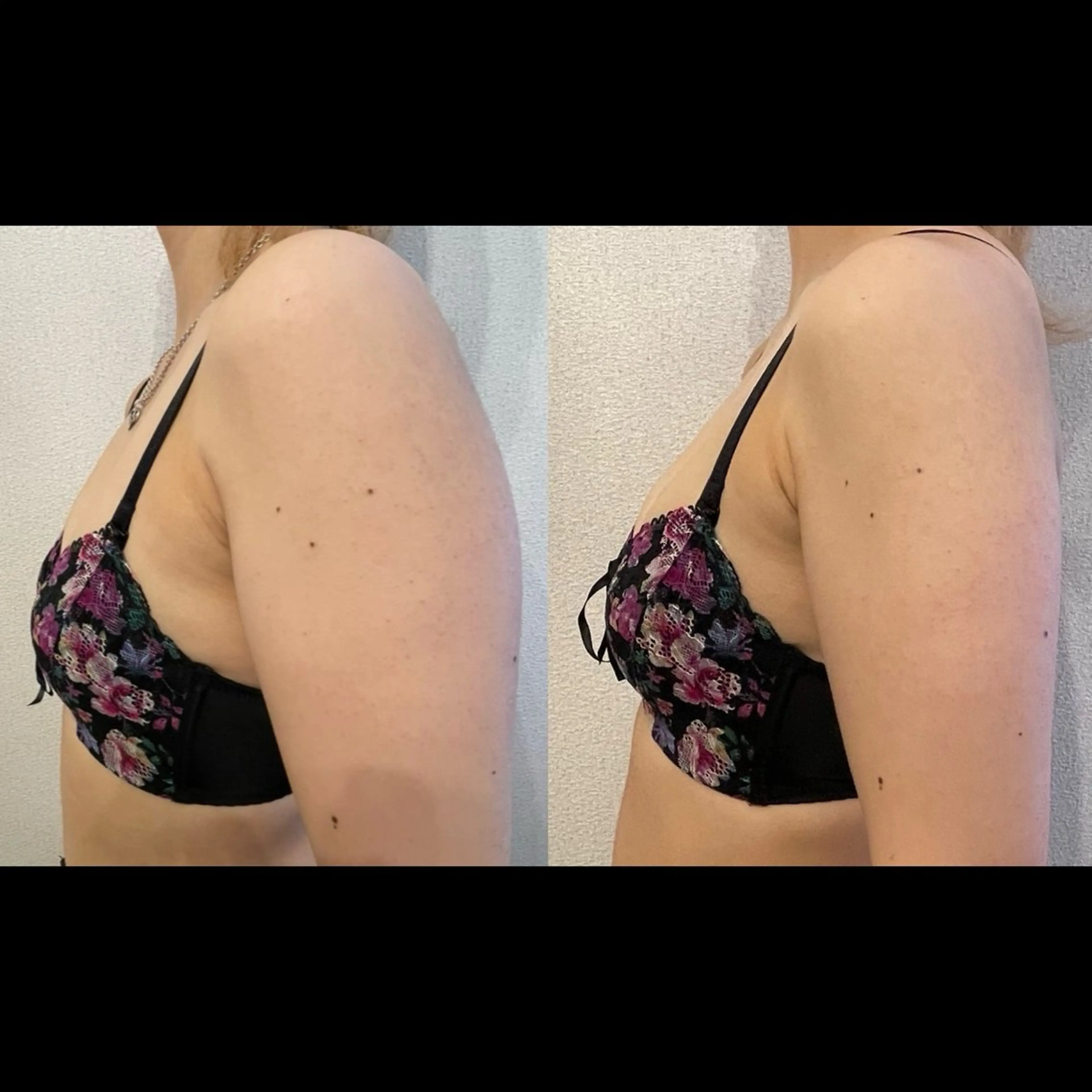 【肩幅キュッとキャシャ見せ施術✨】悩んでいた肩幅もキュッと狭くなる！！二の腕もスッキリで洋服選びが楽しくなる💓の写真