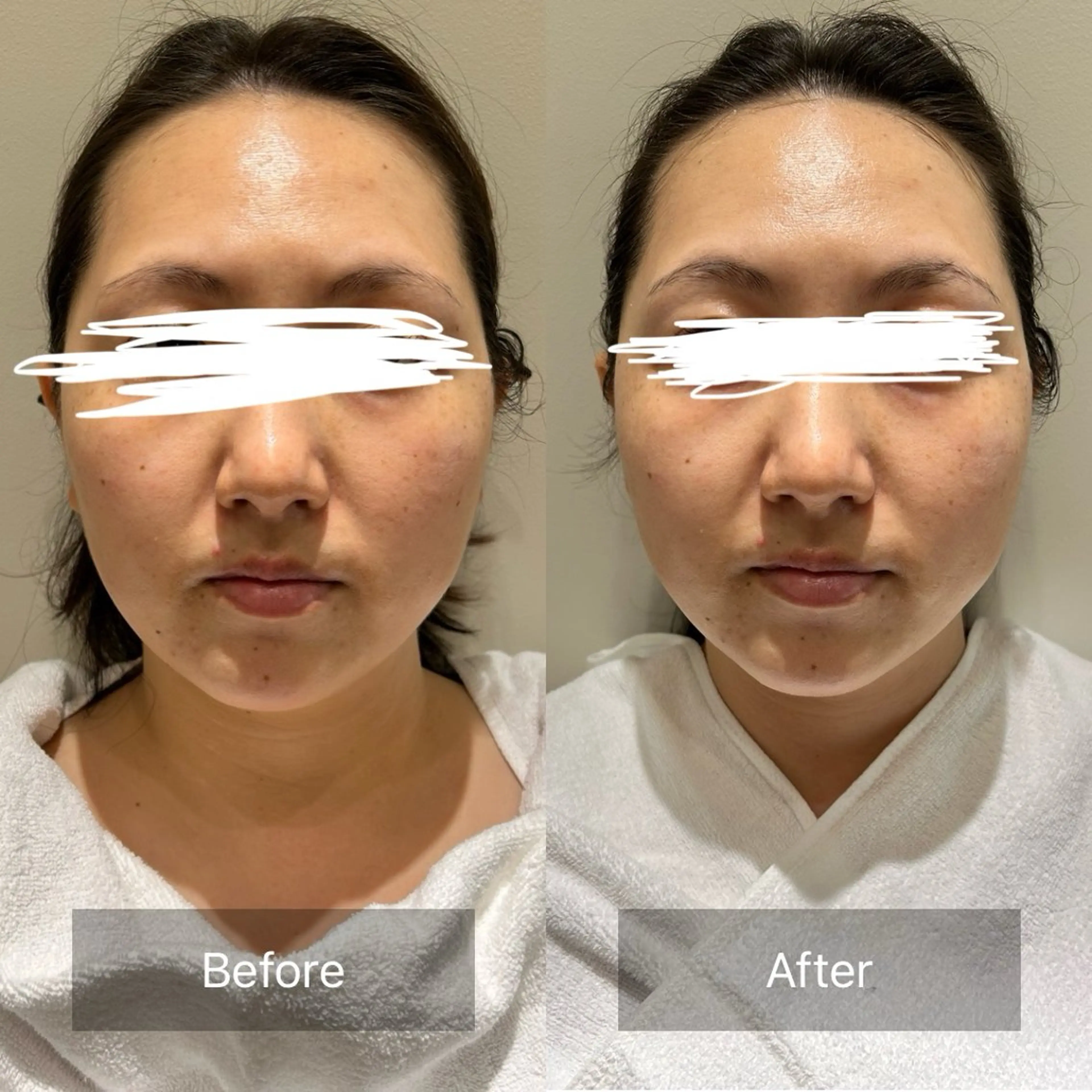 💆‍♀️フェイシャル➕ドライスパ💆‍♀️毛穴撲滅🔥/４Step工程💕の写真