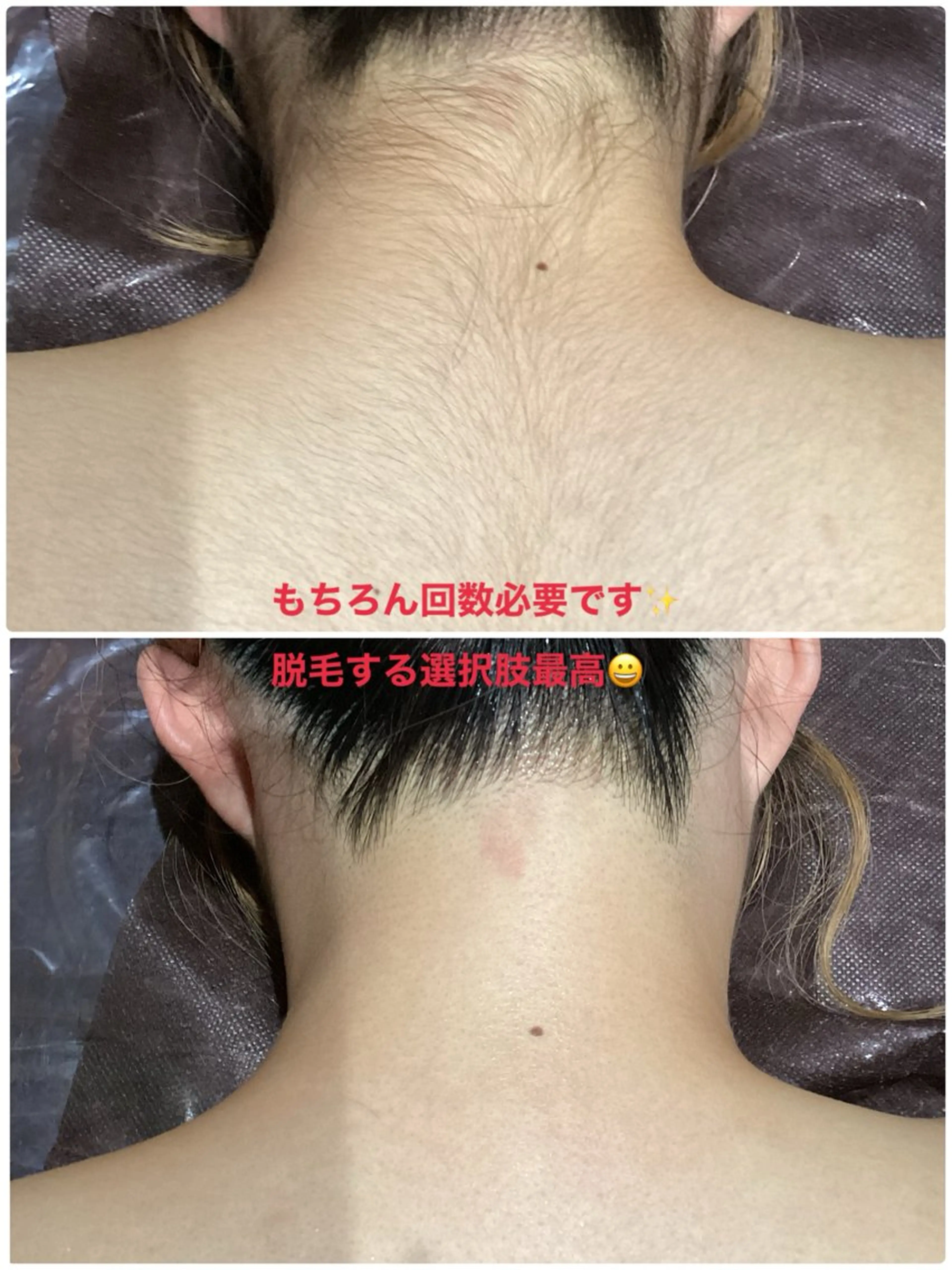 20代限定【全身＋VIO】1番人気🥇全箇所自己処理不要💁🏻‍♀️剃らずに来店ok👌1回¥10000→¥9000の写真