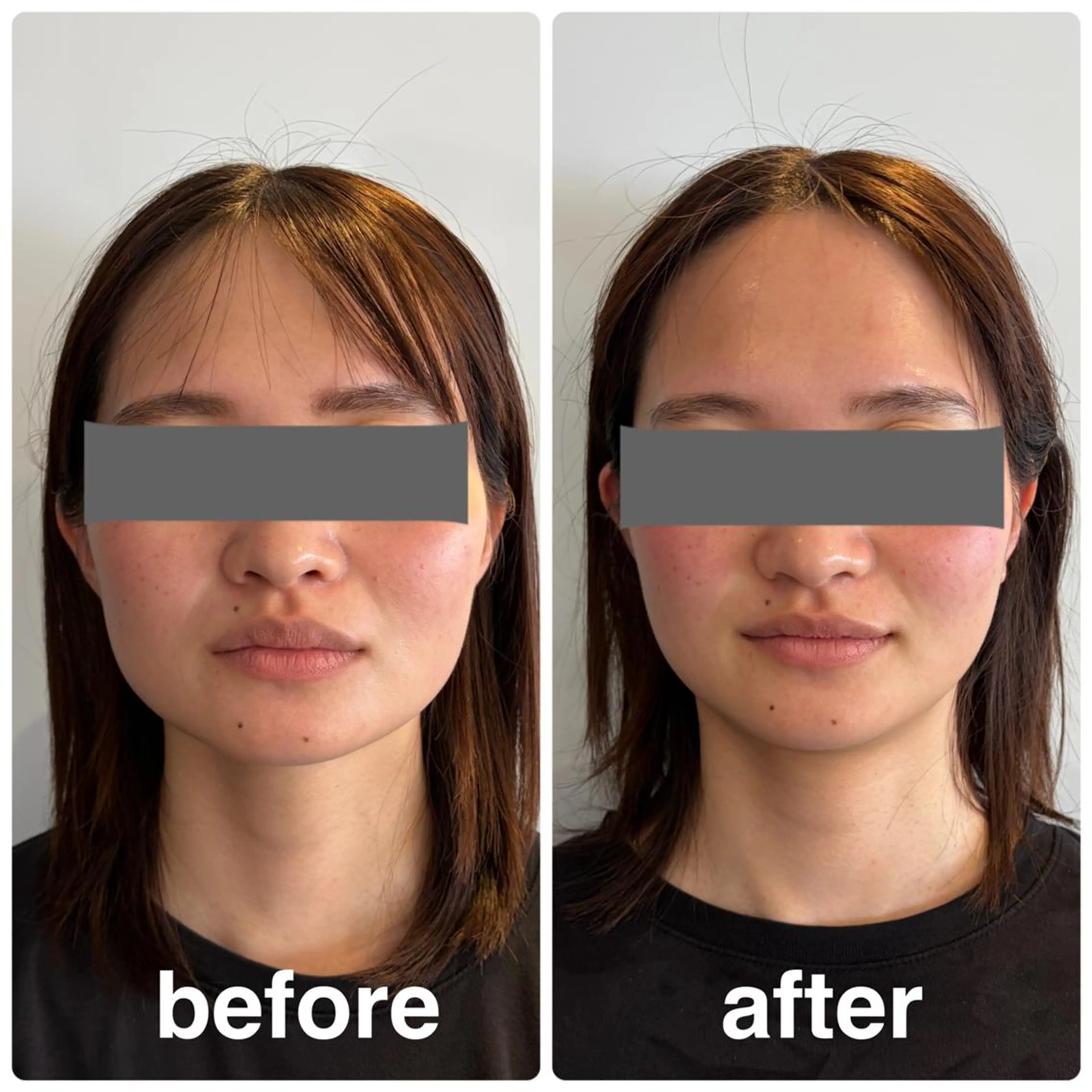 🎁口コミ投稿投稿必須✨小顔矯正+リンパドレナージュ付き(45分) 1000円(税込)の写真