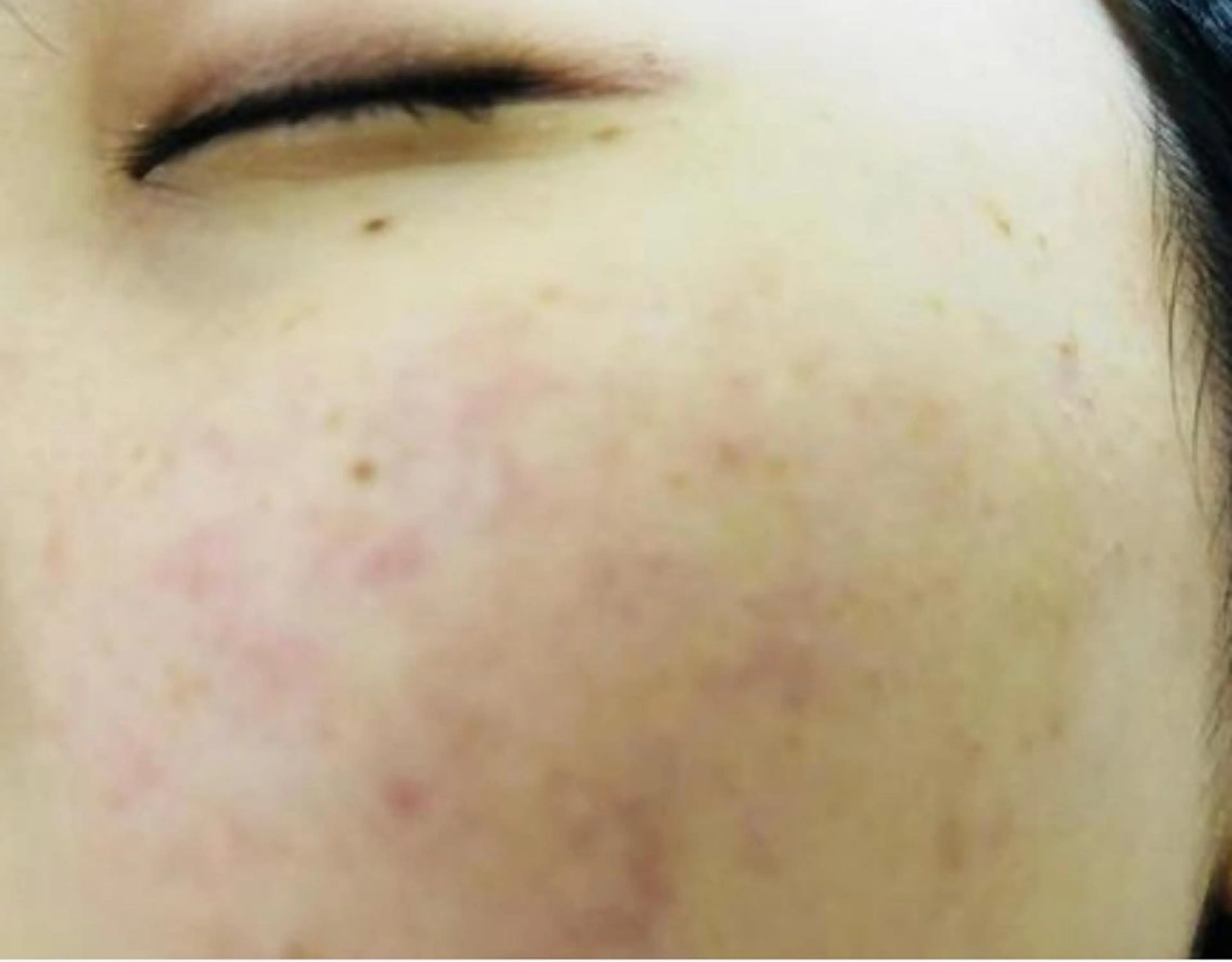 【ニキビケア肌育フェイシャル】の写真