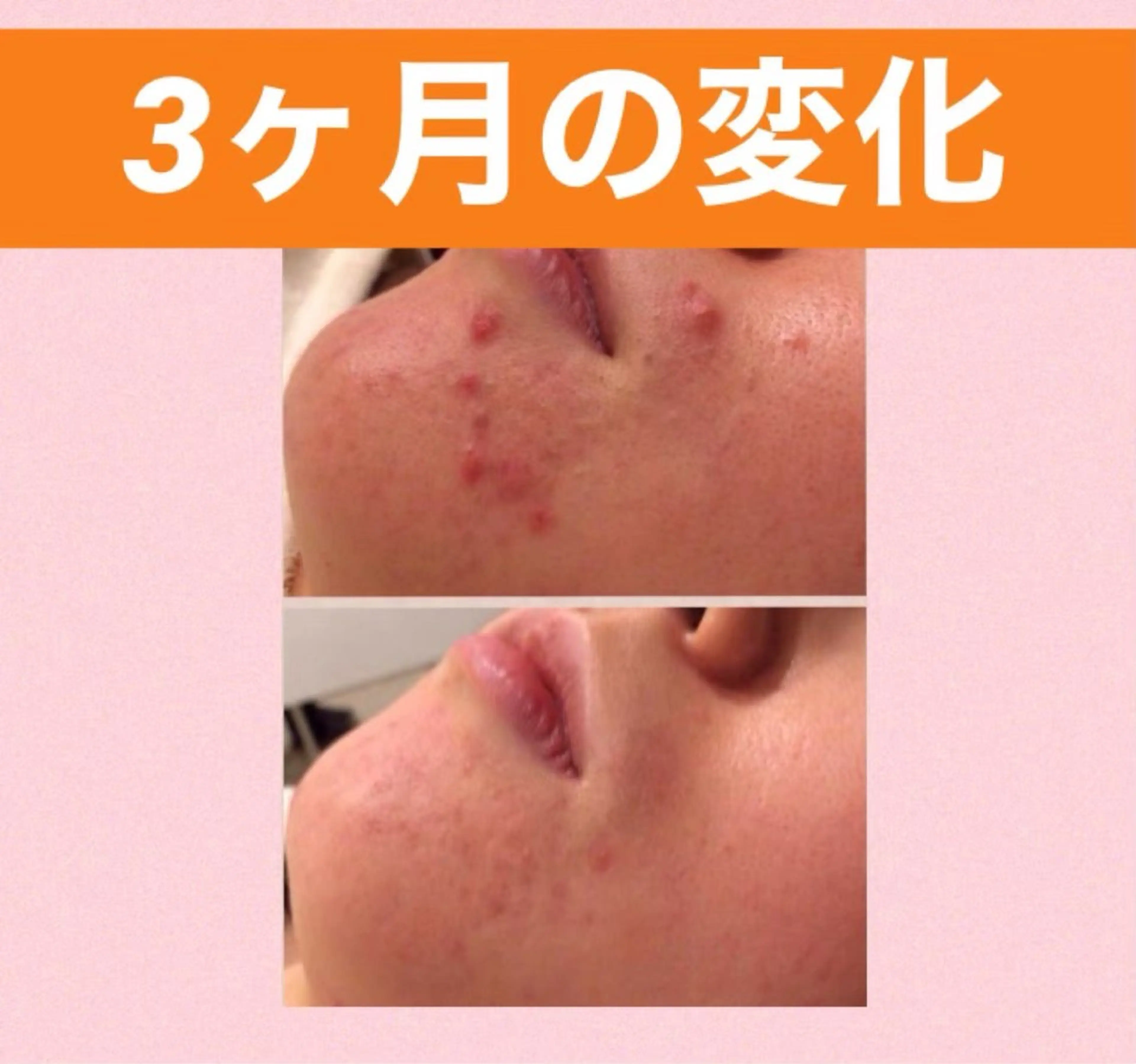 メンズ キッズ ニキビ専門 肌トラブル解消サロンのエステ・リラクイメージ