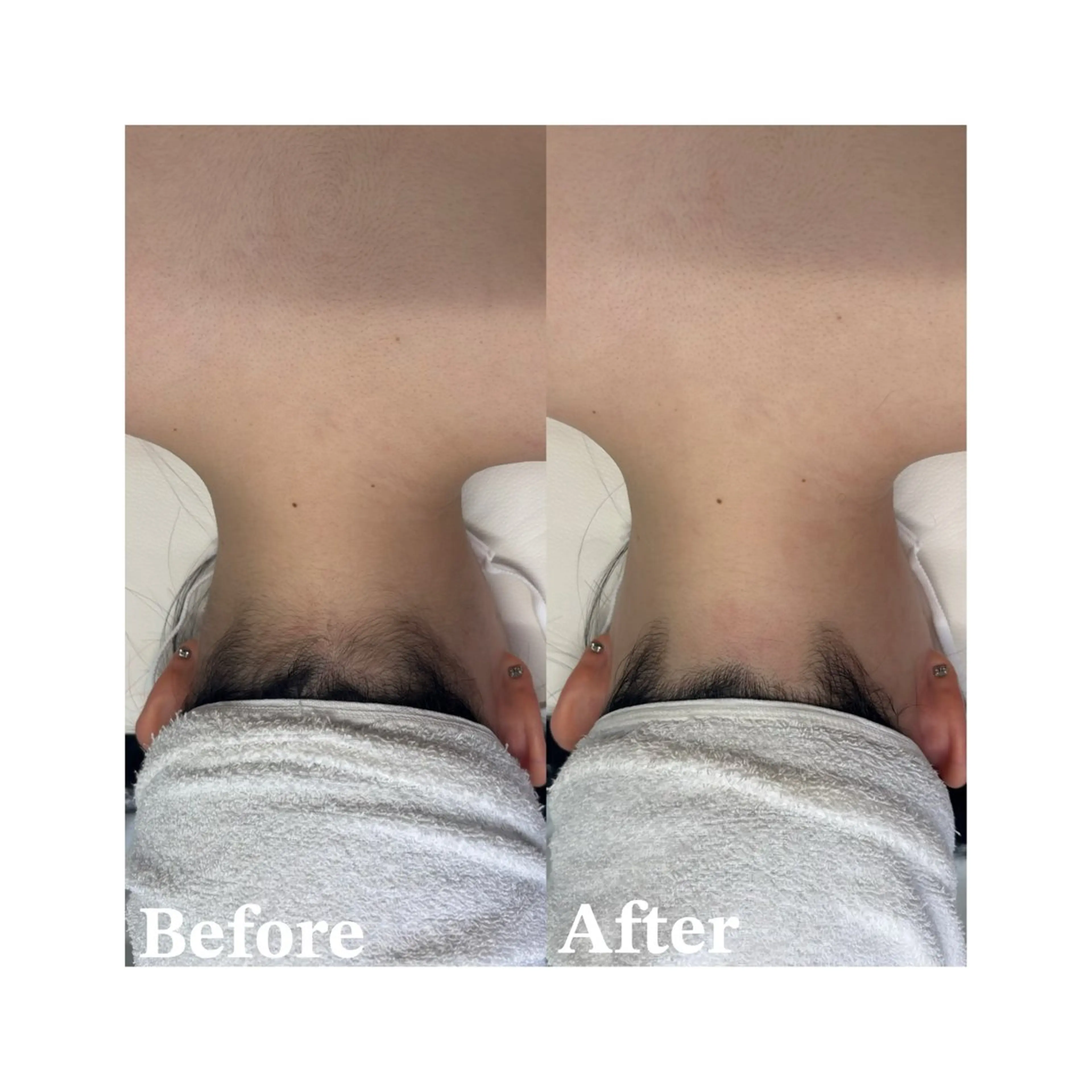 脱毛 サキ 脱毛.エステ🩵ྀིのエステ・リラクイメージ