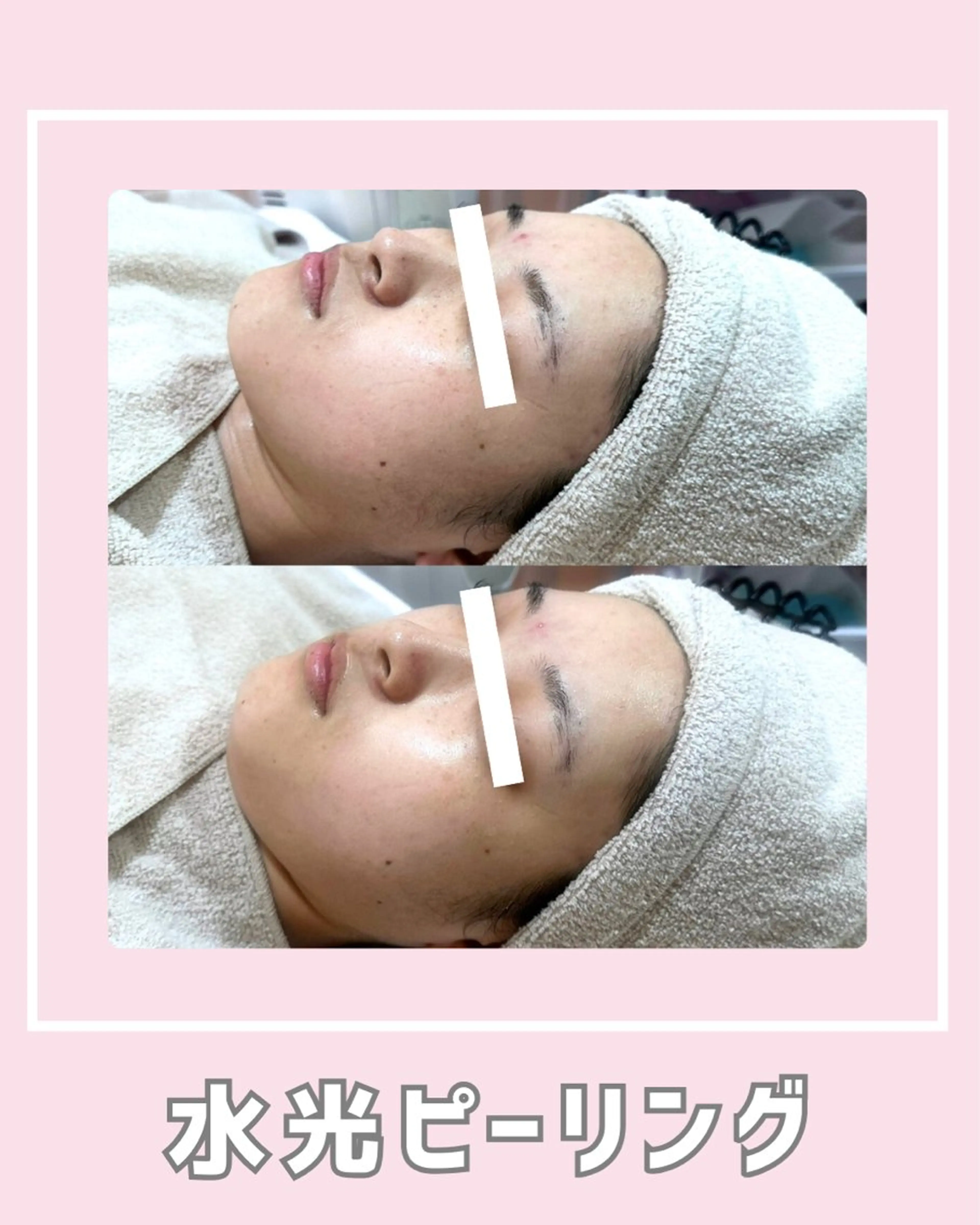 エステ |ピーリング・毛穴| soina神楽坂のエステ・リラクイメージ