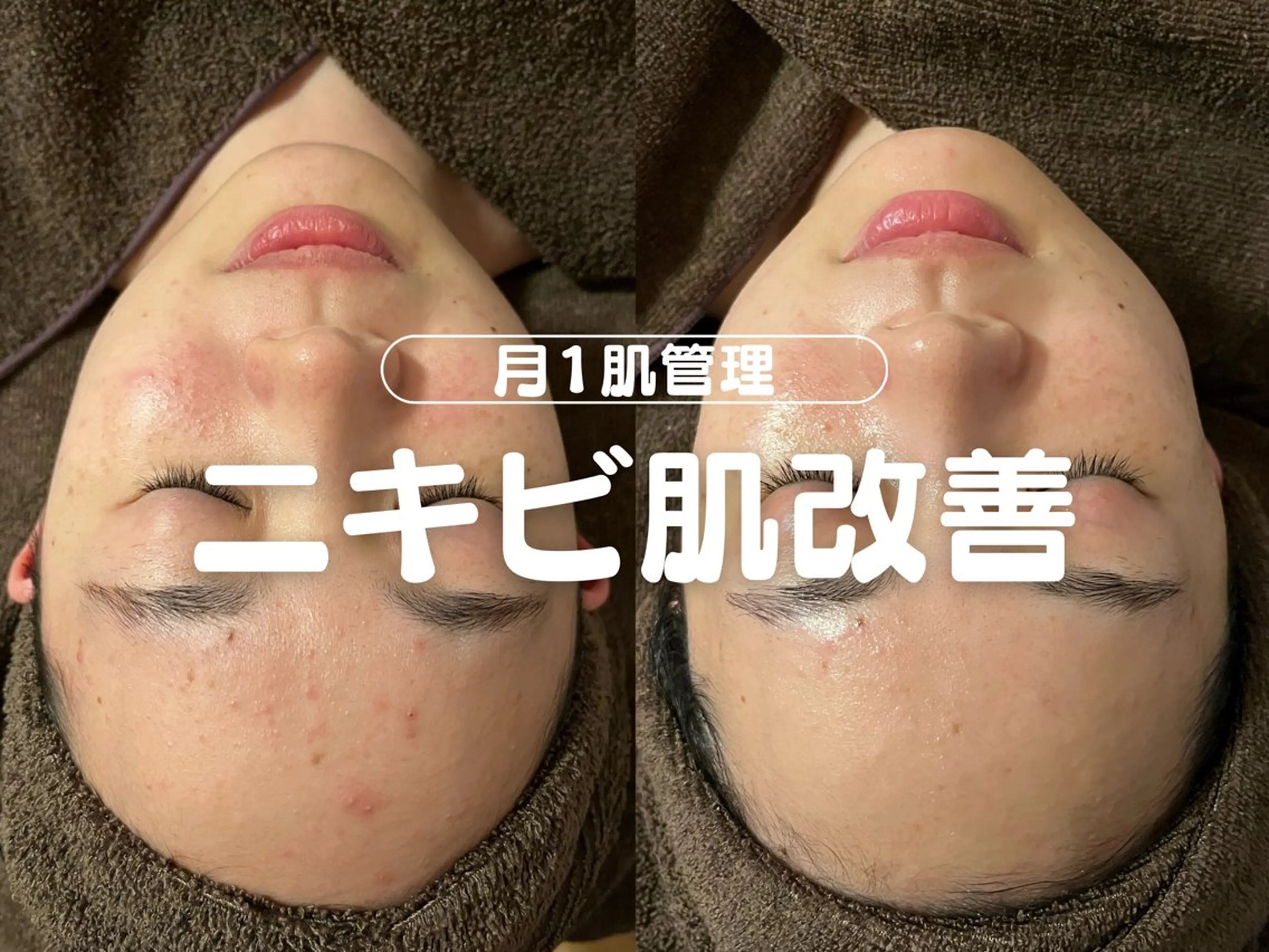 【人気No.1🥇】オーダーメイド肌質改善🌿【肌タイプに合わせたオーダーメイド施術💎💎フルオプション込み価格】の写真