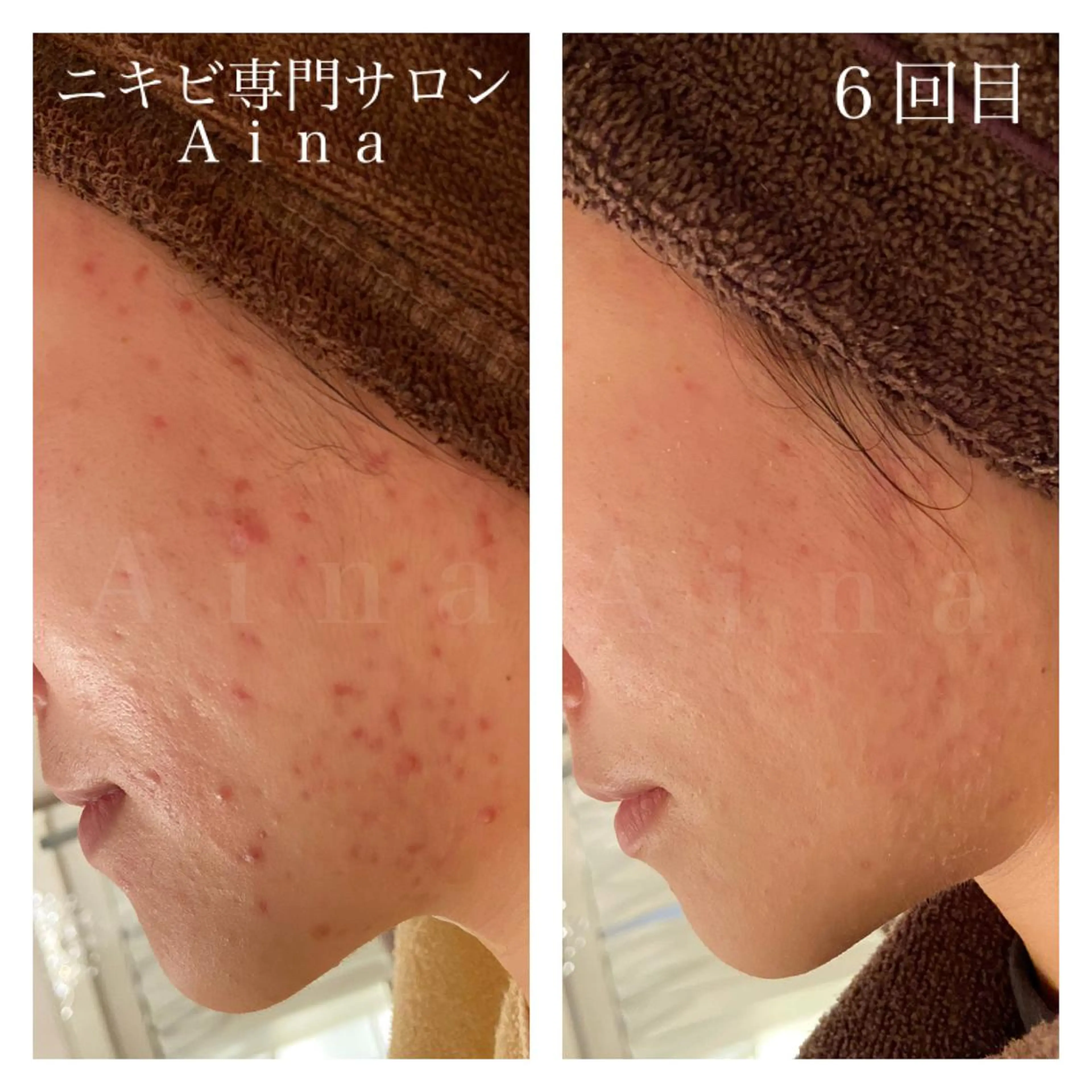 セミロング カラー パーマ ヘアアレンジ メンズ キッズ ネイル マツエク・マツパ 赤色 エステ リラク ニキビ跡専門サロン Ainaのエステ・リラクイメージ
