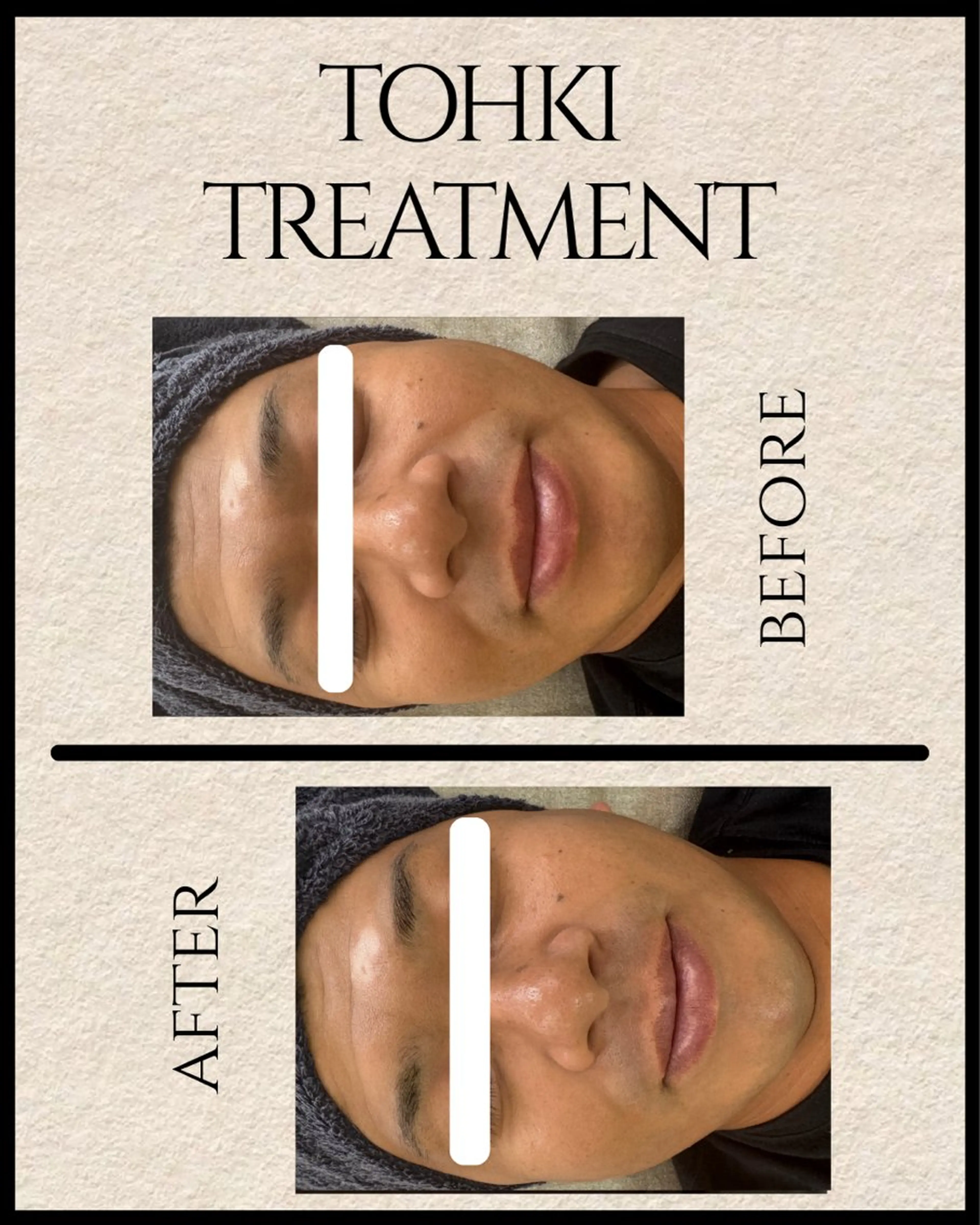 エステ Omi〻北九州 ハーブピーリングのエステ・リラクイメージ