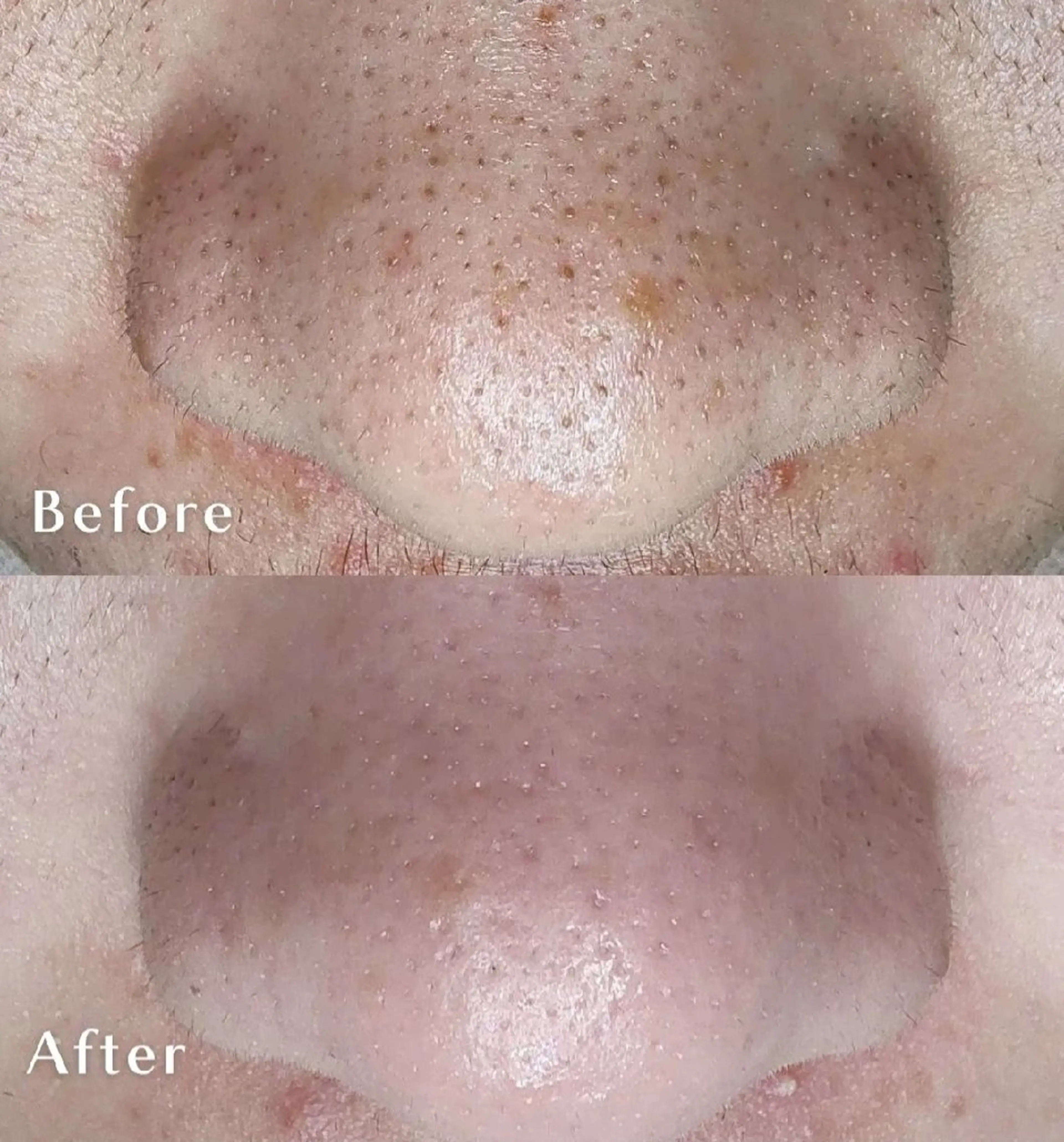 毛穴洗浄 90分 レディースメンズOK👌の写真