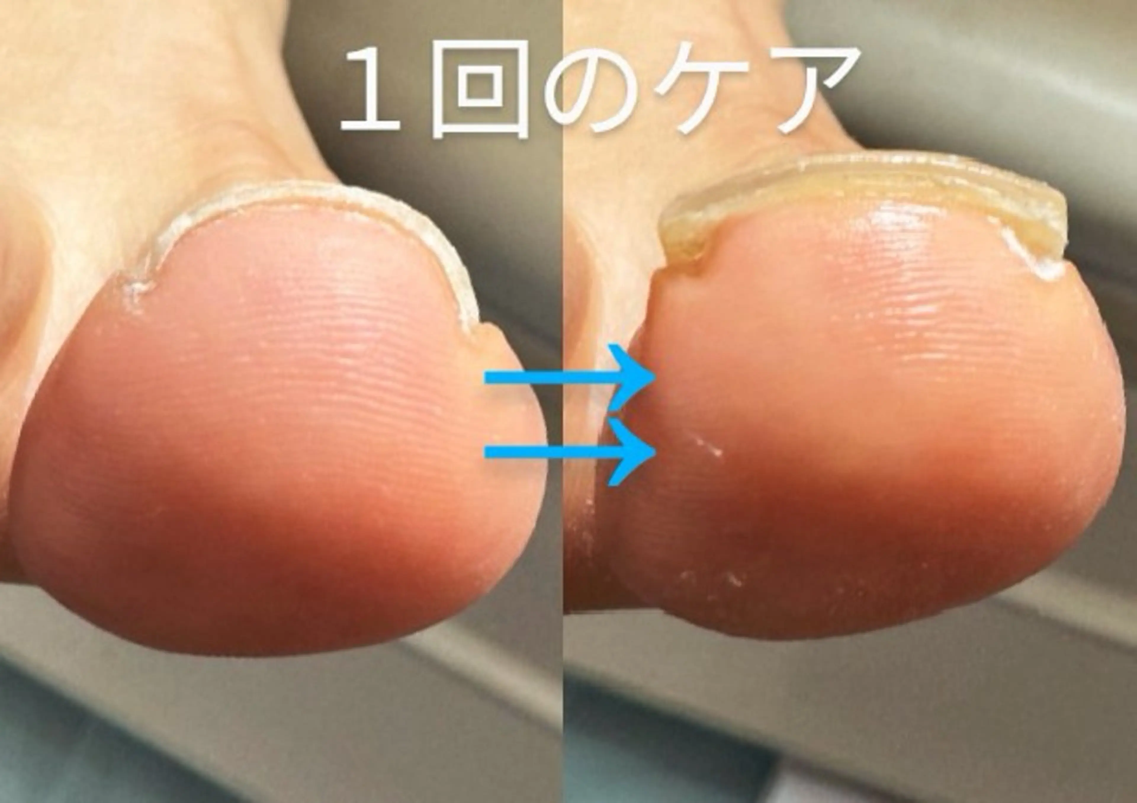 フット巻き爪ケア（親指1本）　★プレート【クリップオン）】orジェル【ヘイスイッチ】　5800円​〜​8000円の写真